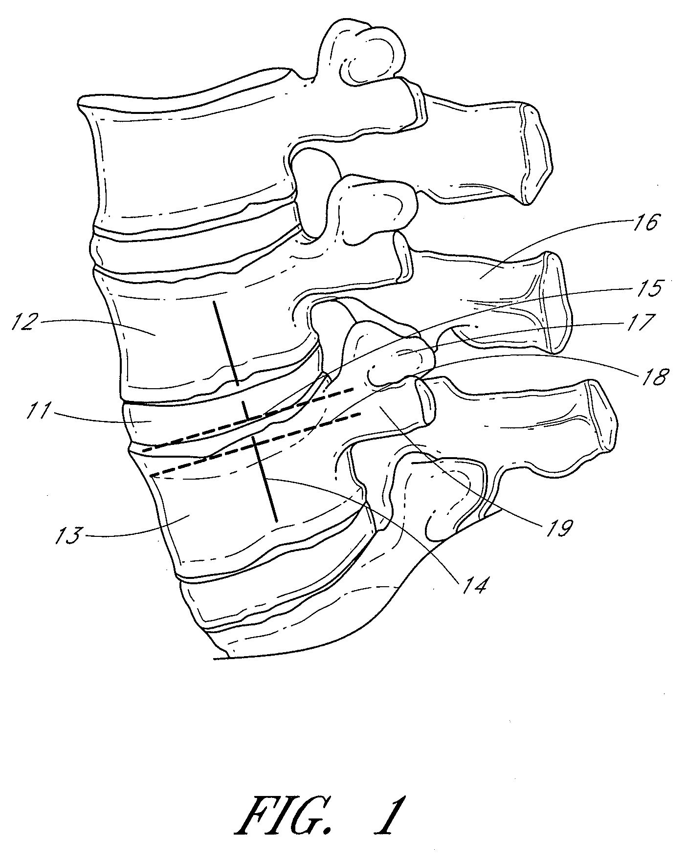 Methods, systems and apparatuses for torsional stabilization
