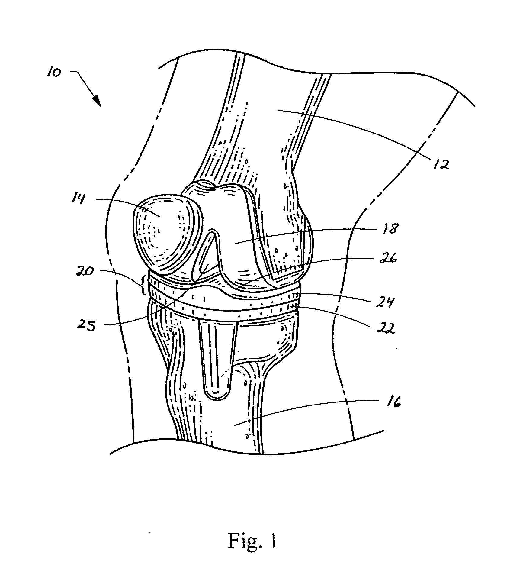 Device and method of spacer and trial design during joint arthroplasty