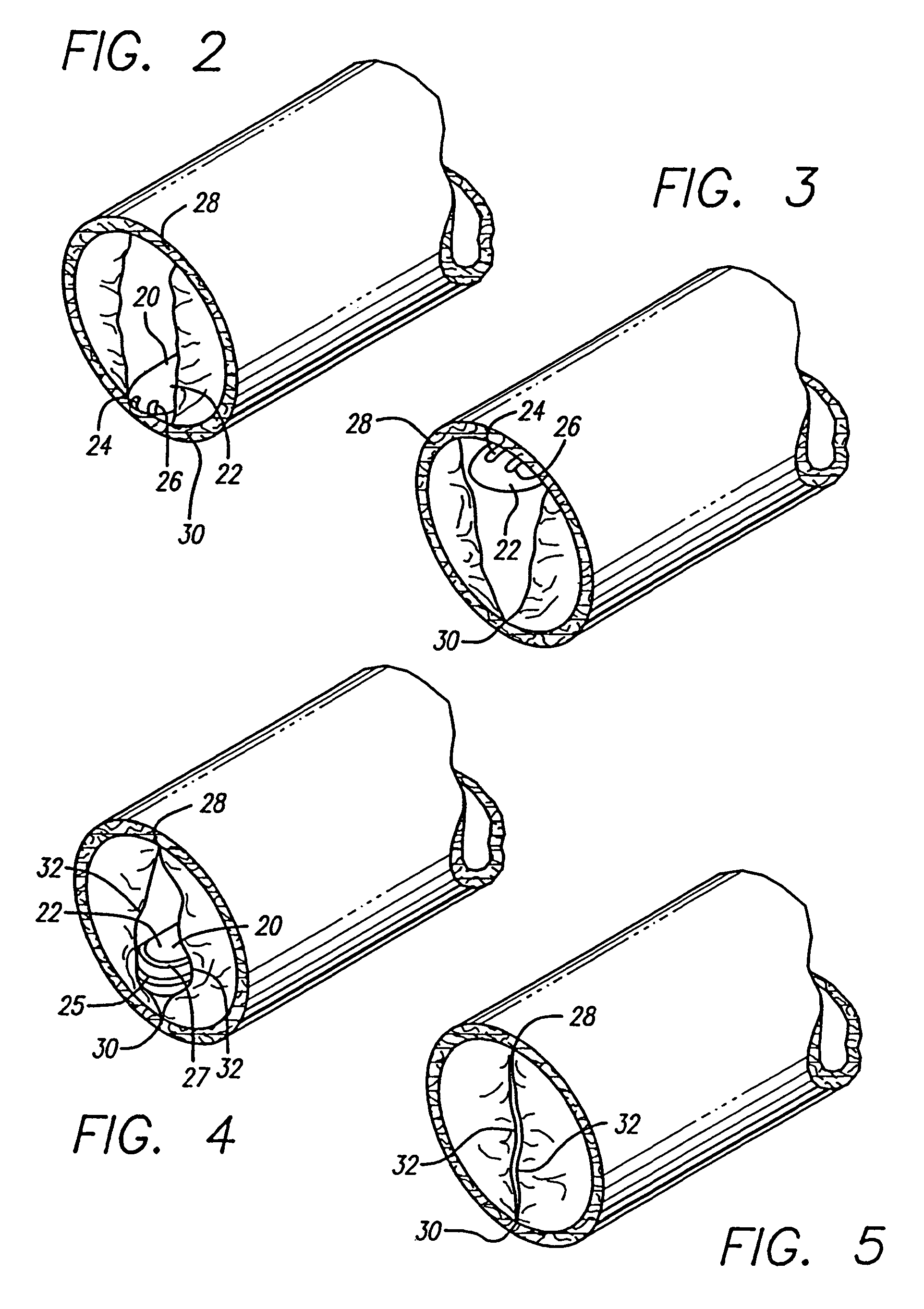 Method and apparatus for treating venous insufficiency using directionally applied energy