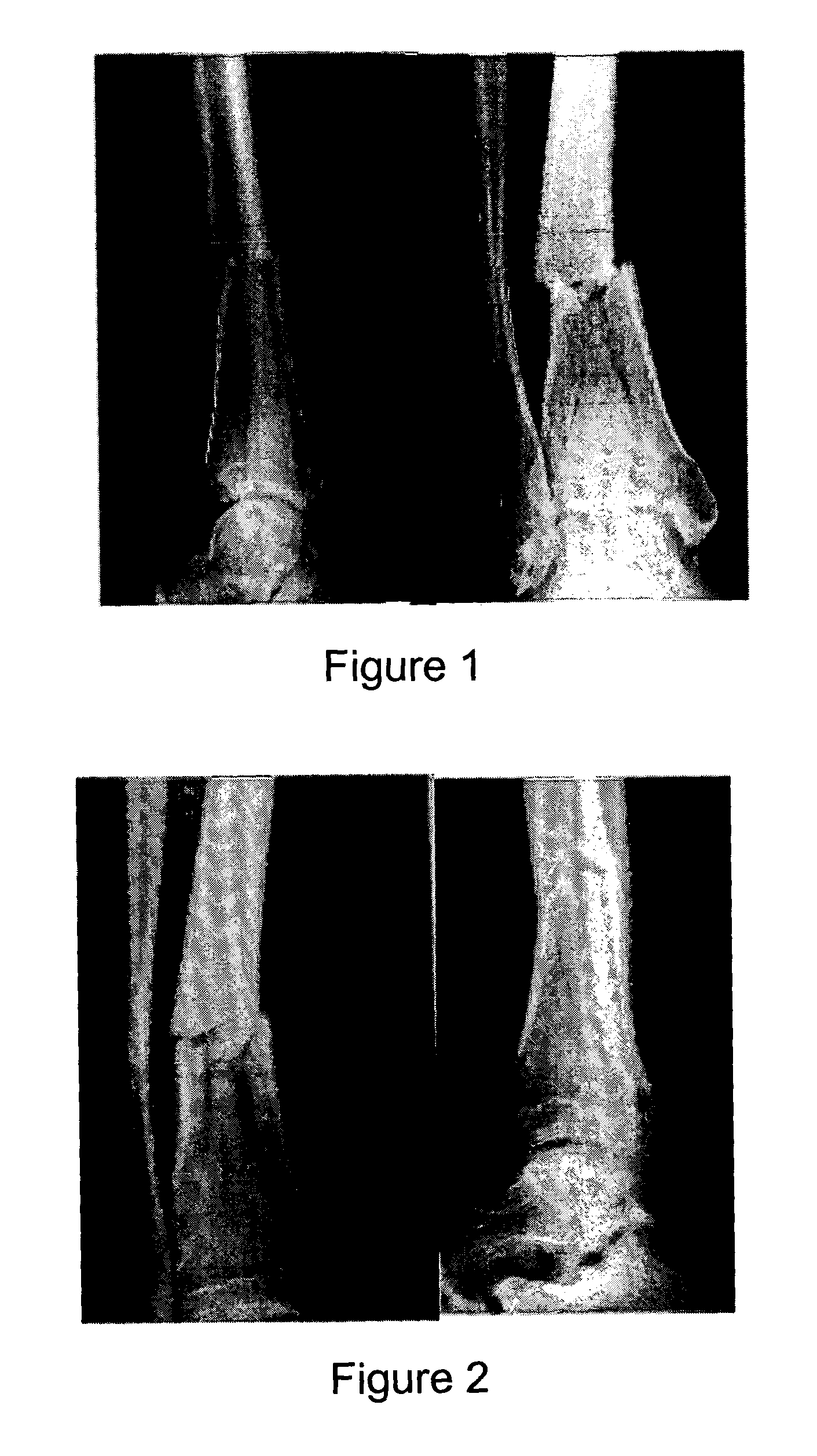 Composition and method for facilitating bone healing