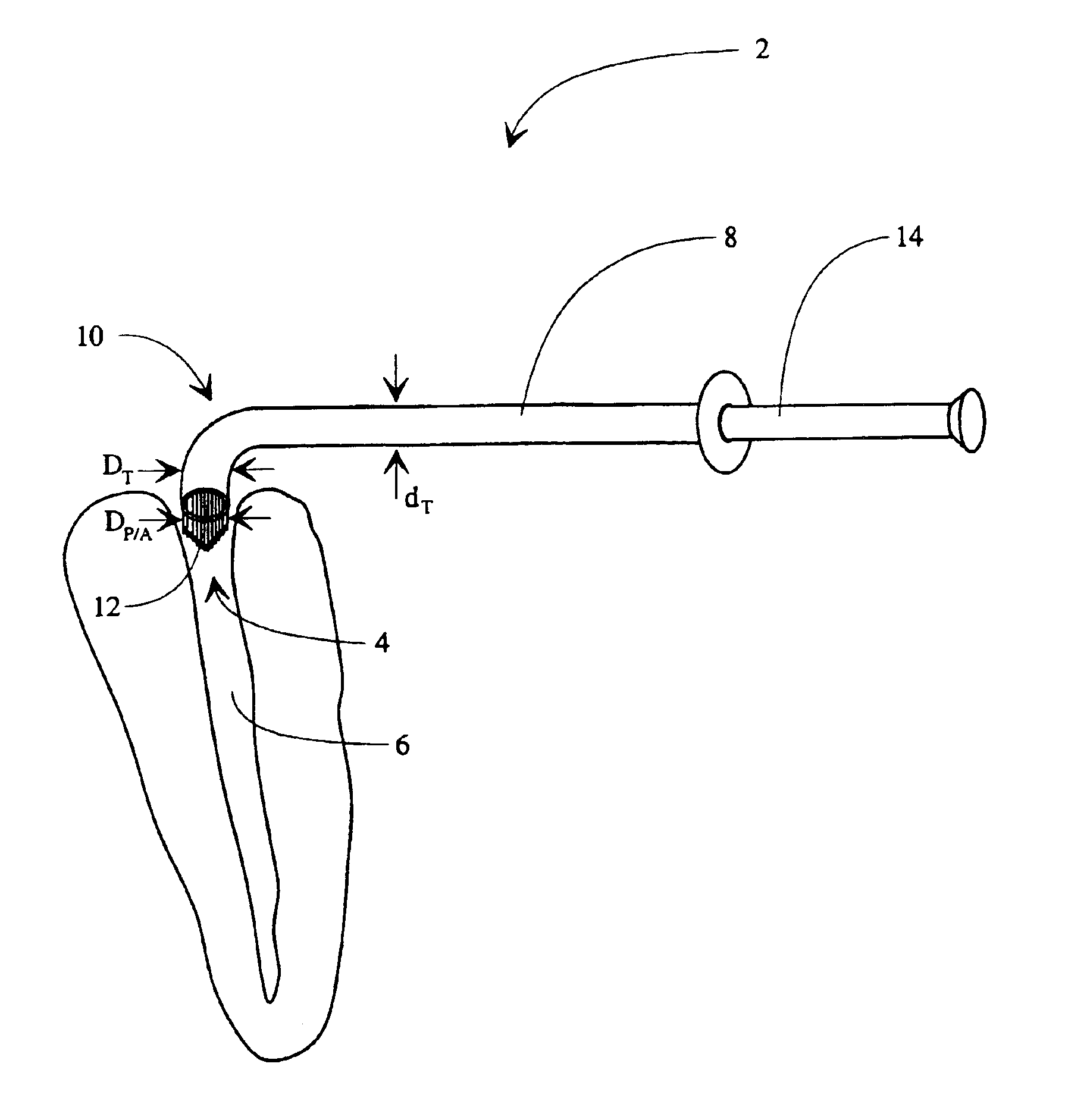 Applicator system for dental posts and anchors and use of said applicator system