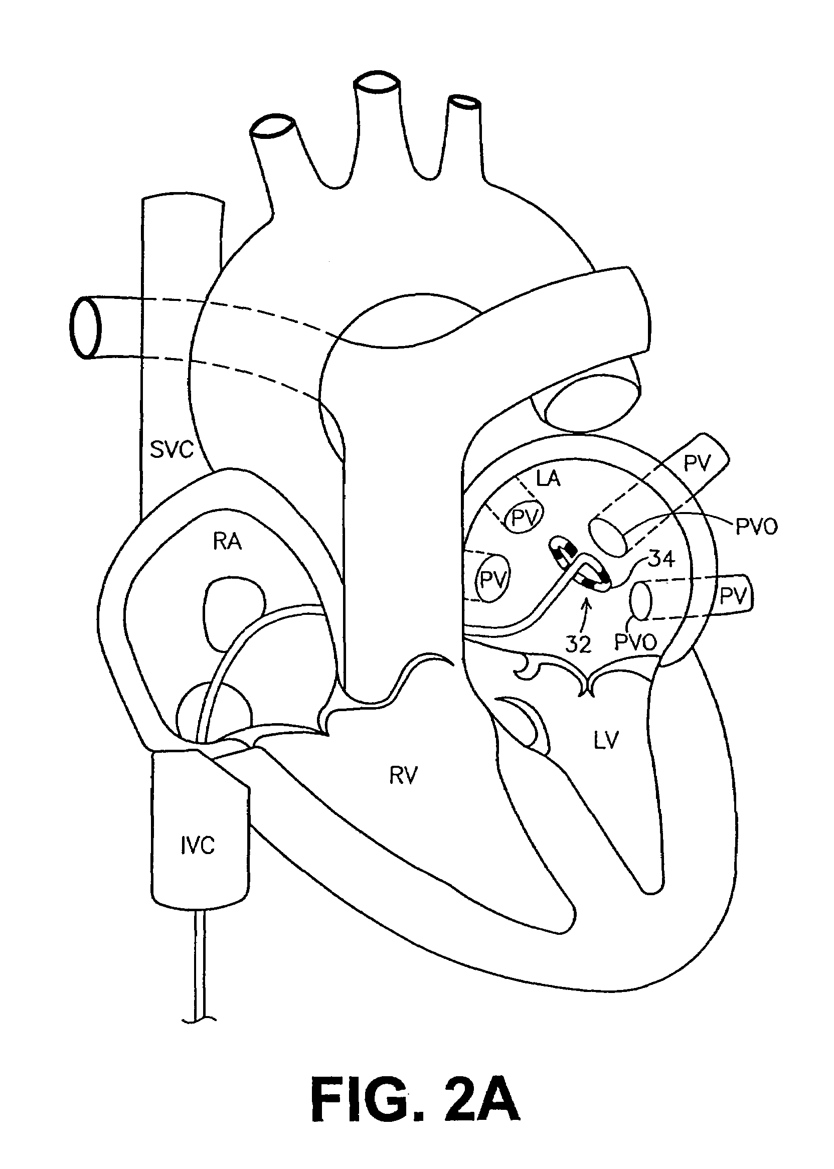 Ablation catheter assembly and method for isolating a pulmonary vein