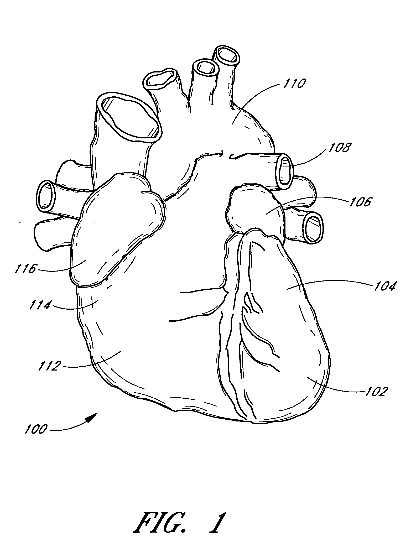 Patent foramen ovale closure system