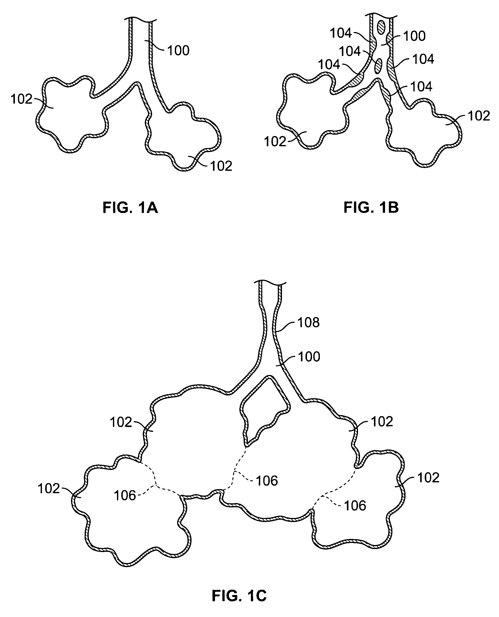 Antiproliferative devices for maintaining patency of surgically created channels in a body organ