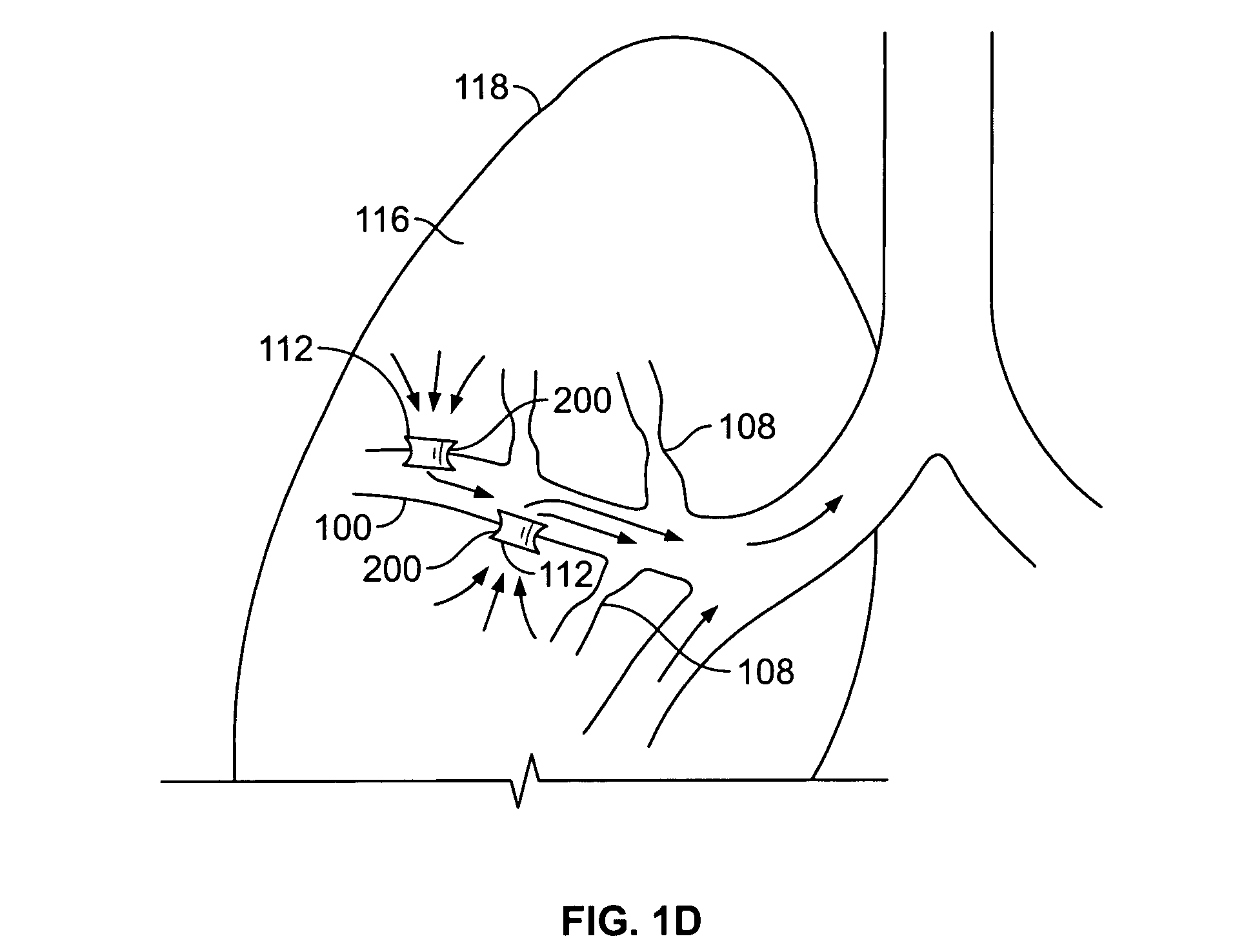 Antiproliferative devices for maintaining patency of surgically created channels in a body organ