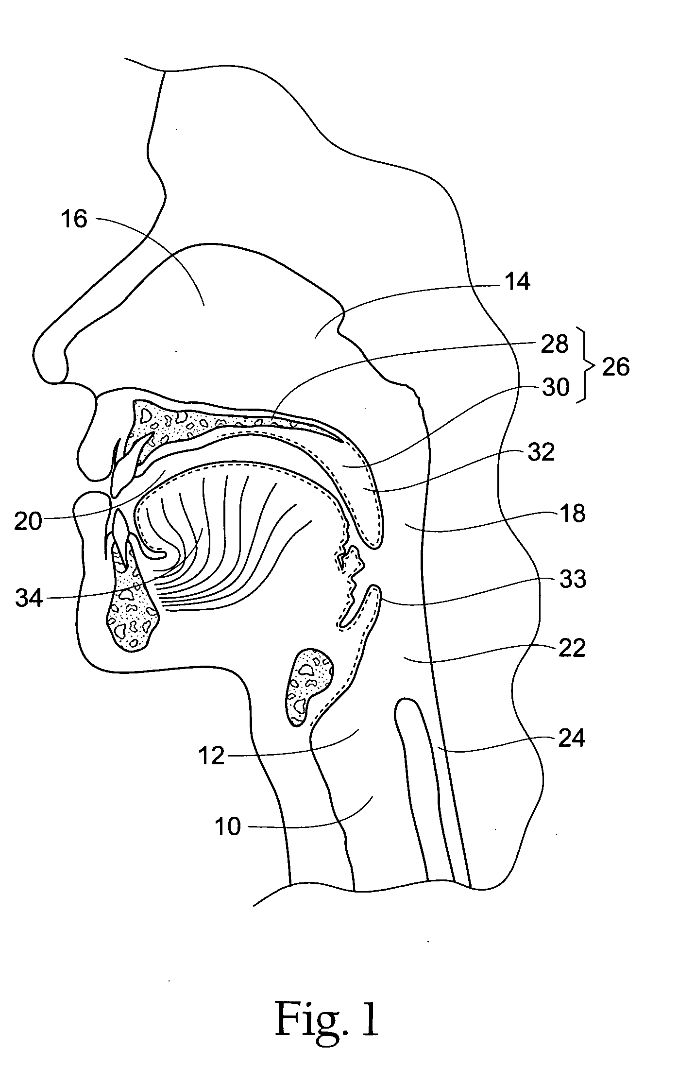 Systems and methods for moving and/or restraining tissue in the upper respiratory system