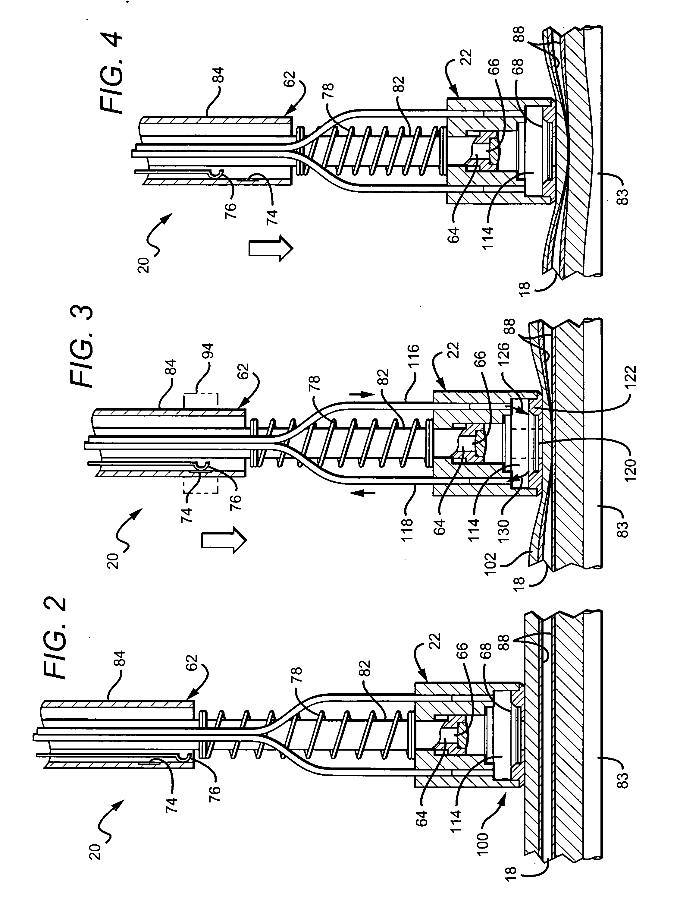 Vascular occlusion systems and methods