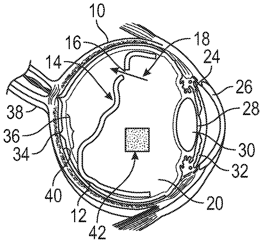 Methods and devices for treating a retinal detachment