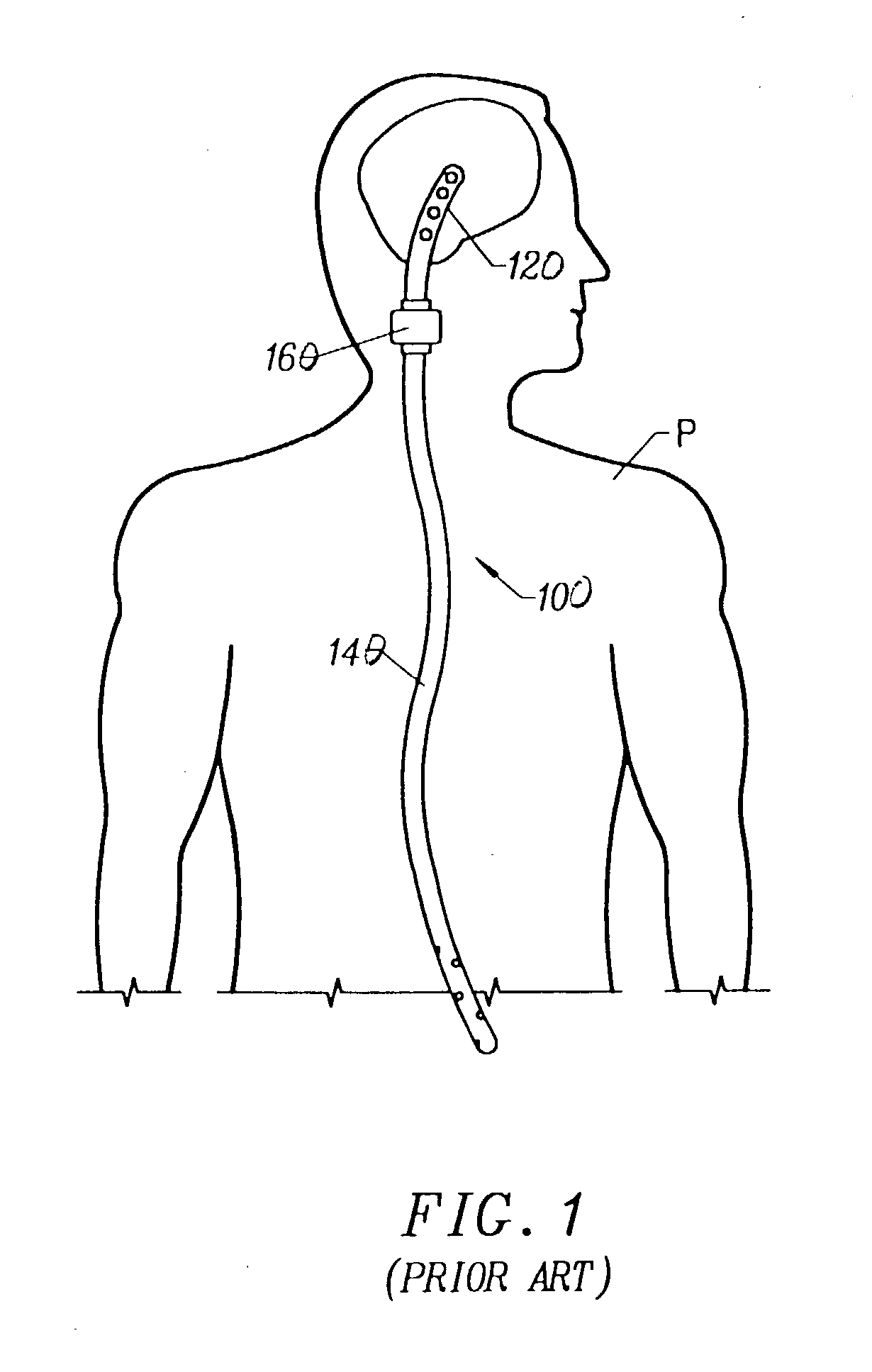 Systems and methods for flow detection and measurement in CSF shunts