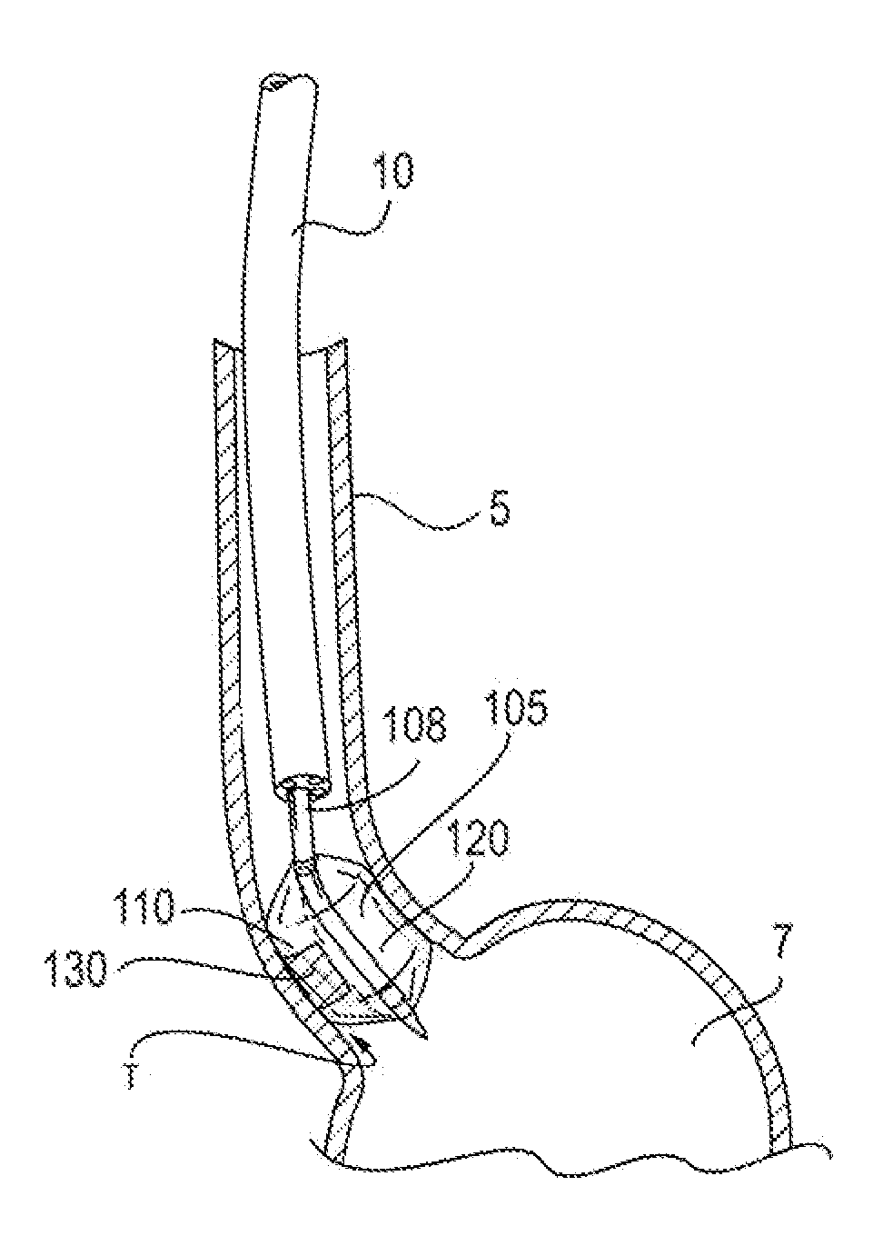 Selectively expandable operative element support structure and methods of use