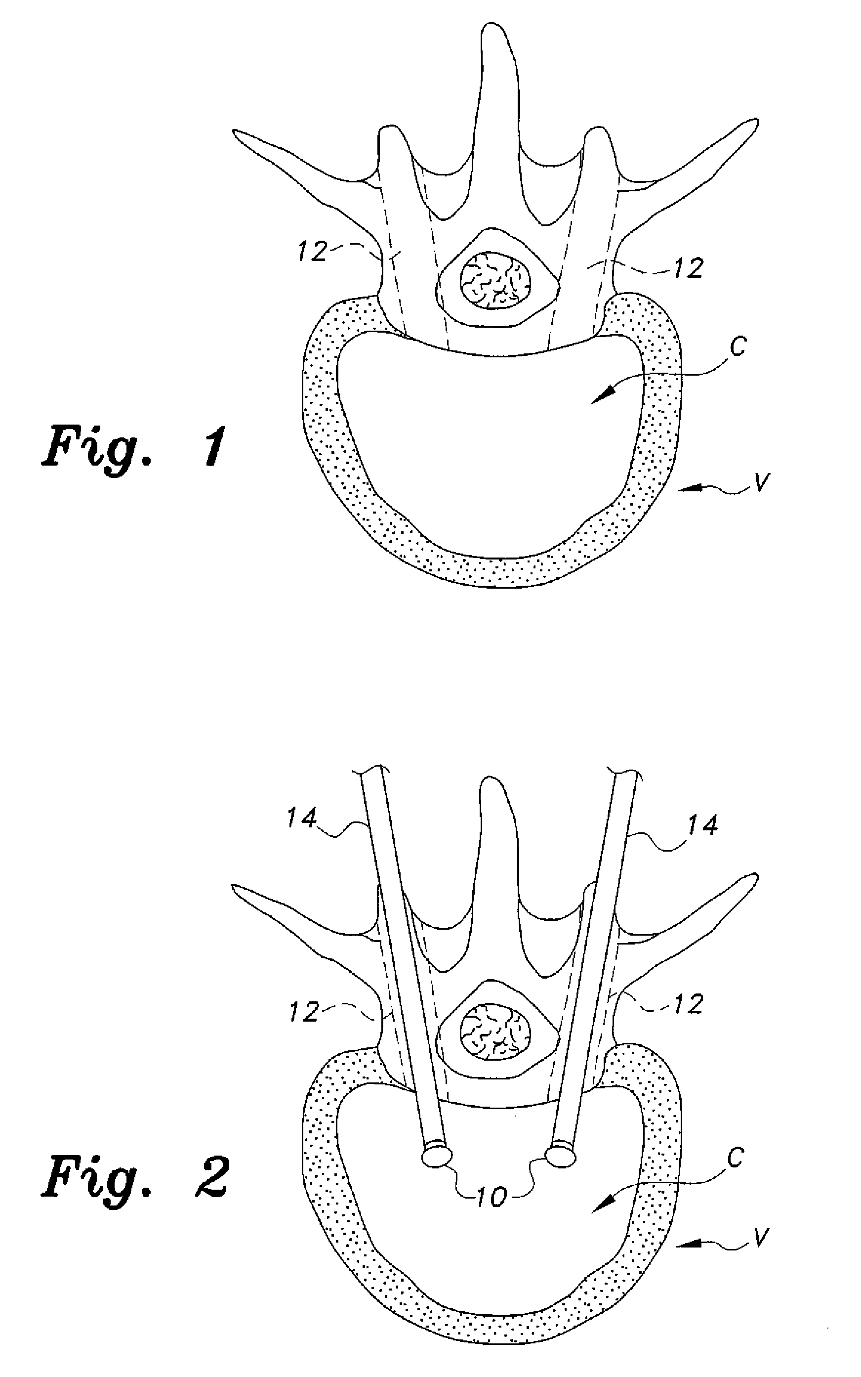 Device and method to prevent extravasation of bone cement used in balloon kyphoplasty