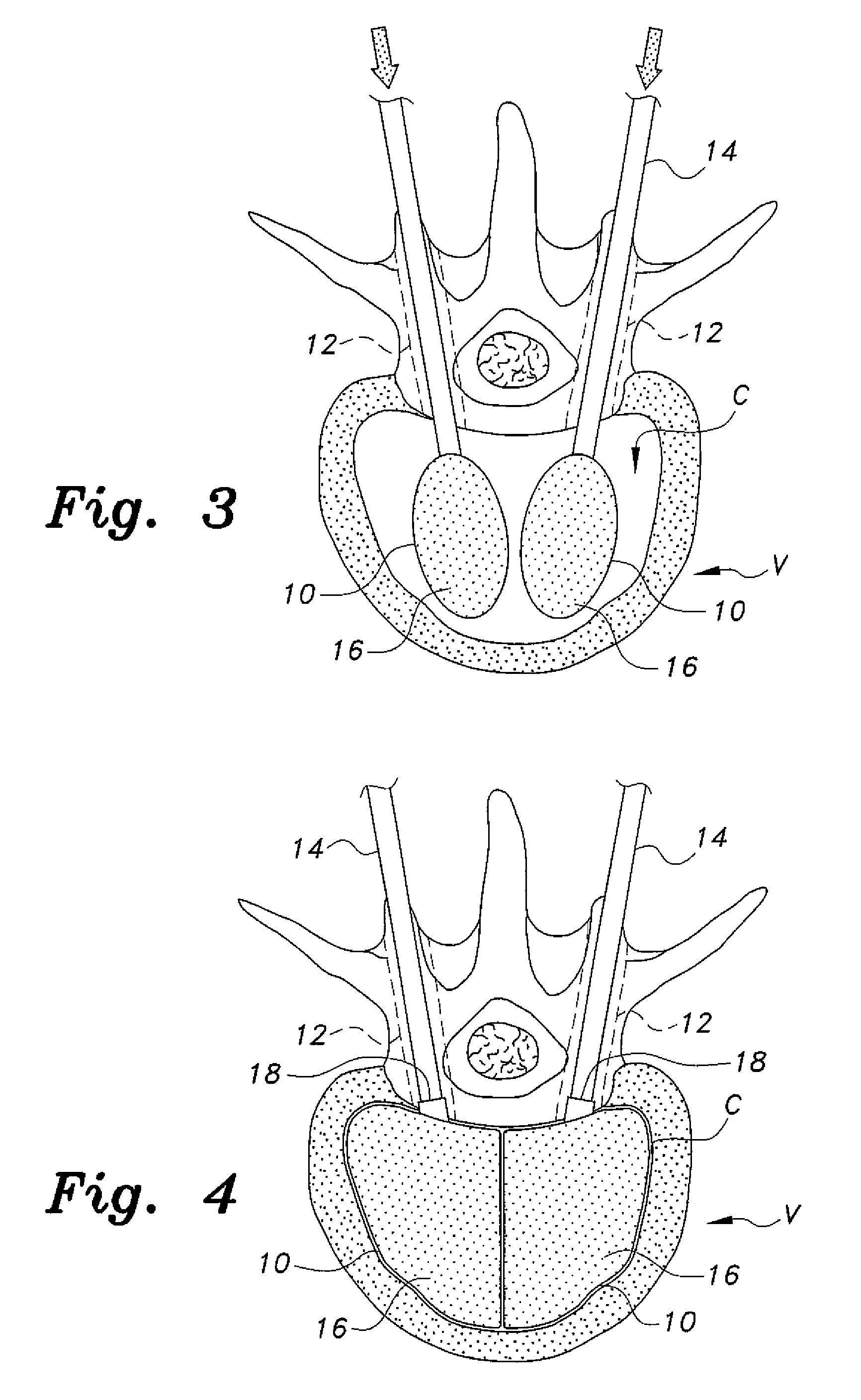 Device and method to prevent extravasation of bone cement used in balloon kyphoplasty