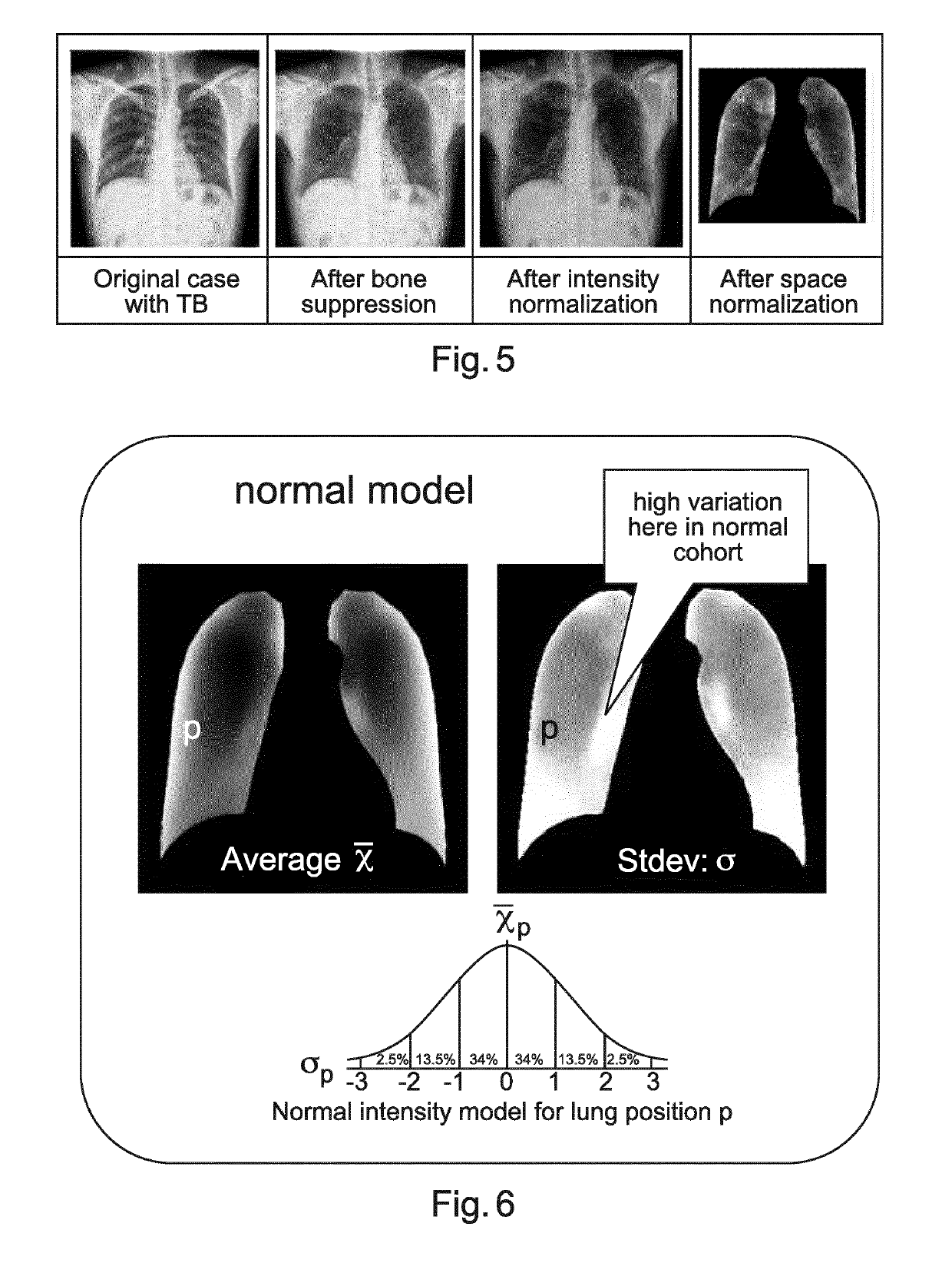 Apparatus for the detection of opacities in x-ray images