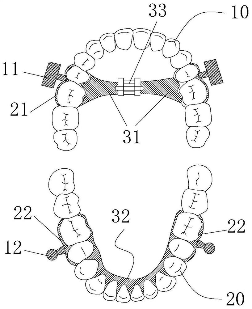 Forward mandibular positioning device for orthodontics