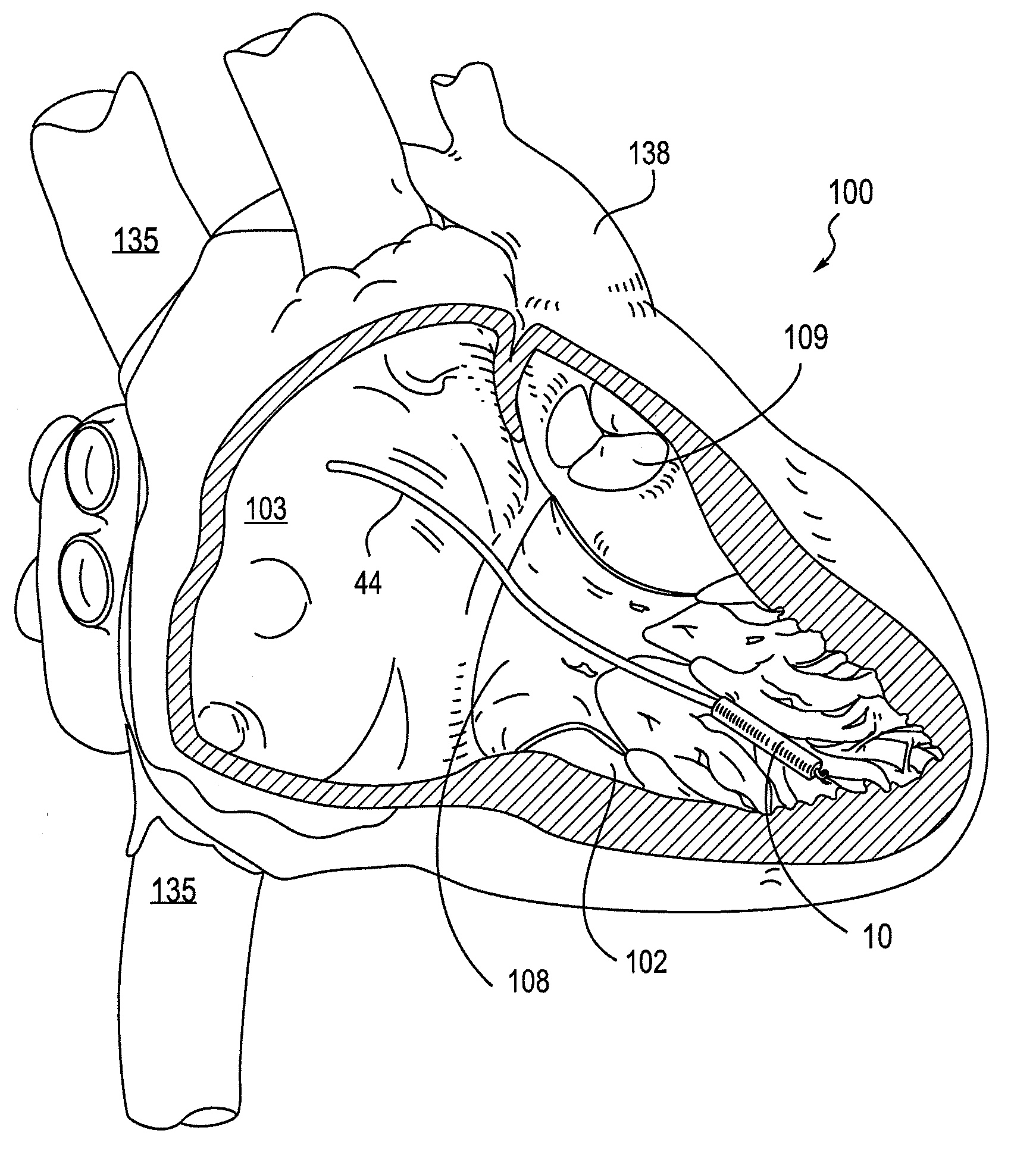 Leadless cardiac pacemaker with secondary fixation capability