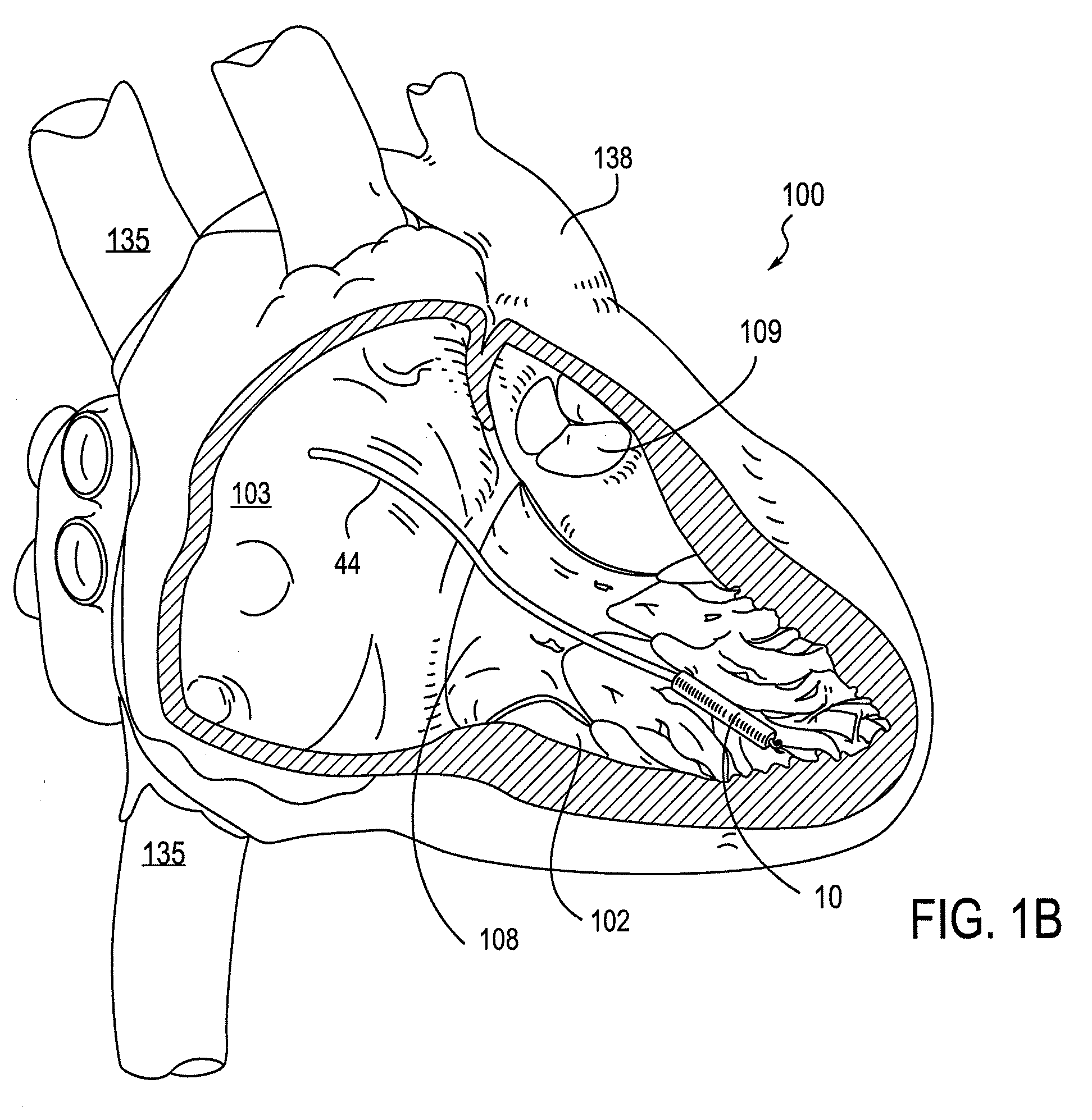 Leadless cardiac pacemaker with secondary fixation capability