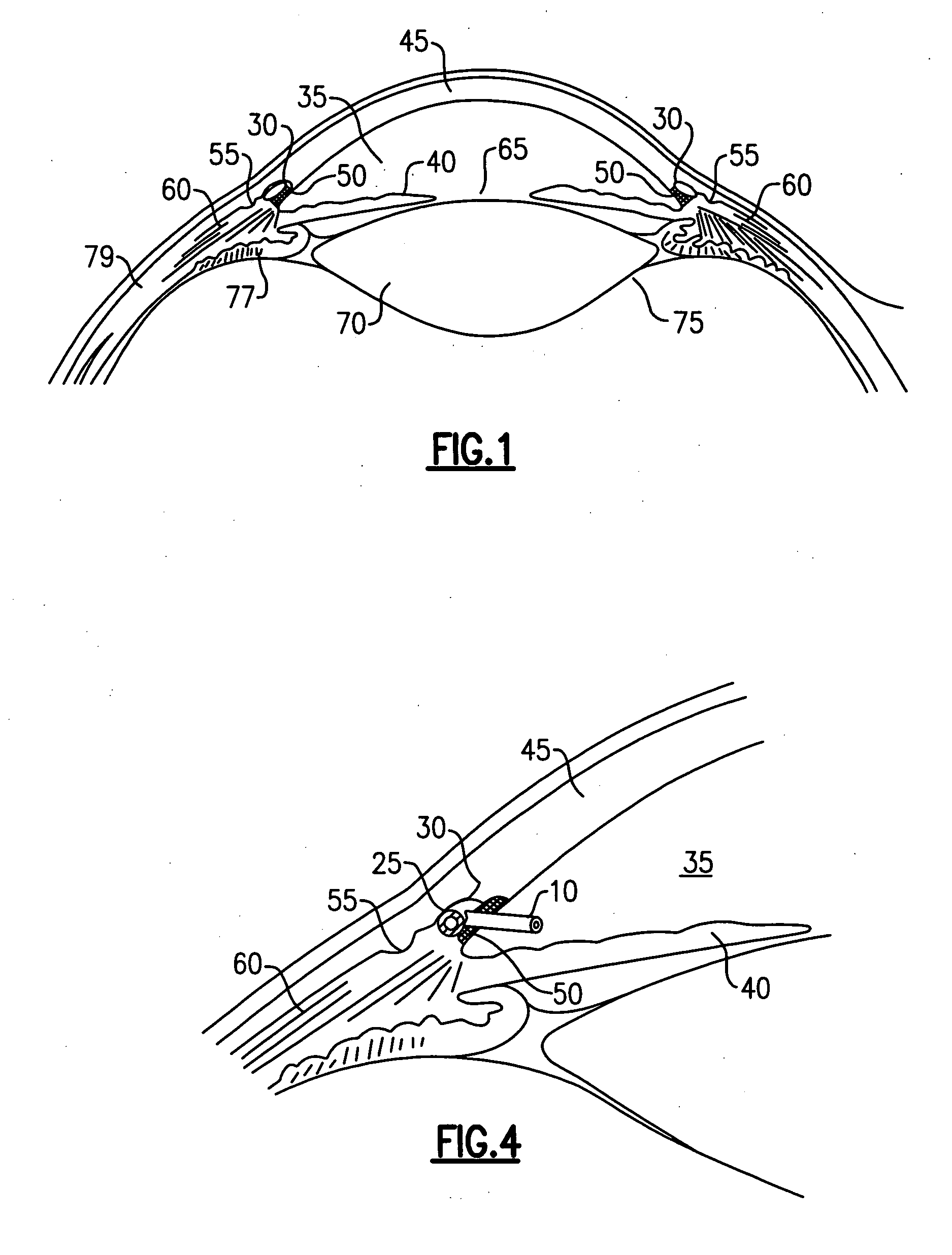 Intraocular shunt device and method