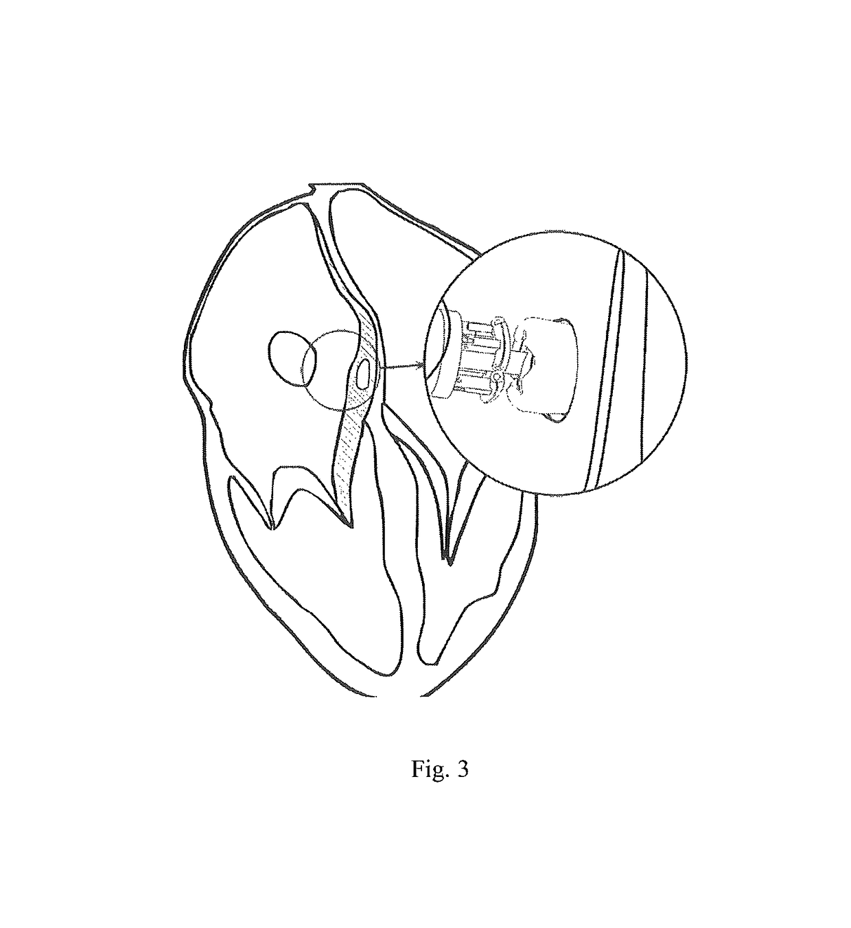 Device for percutaneous transcathertral closure of atrial septal defect by deploying pericardial patch