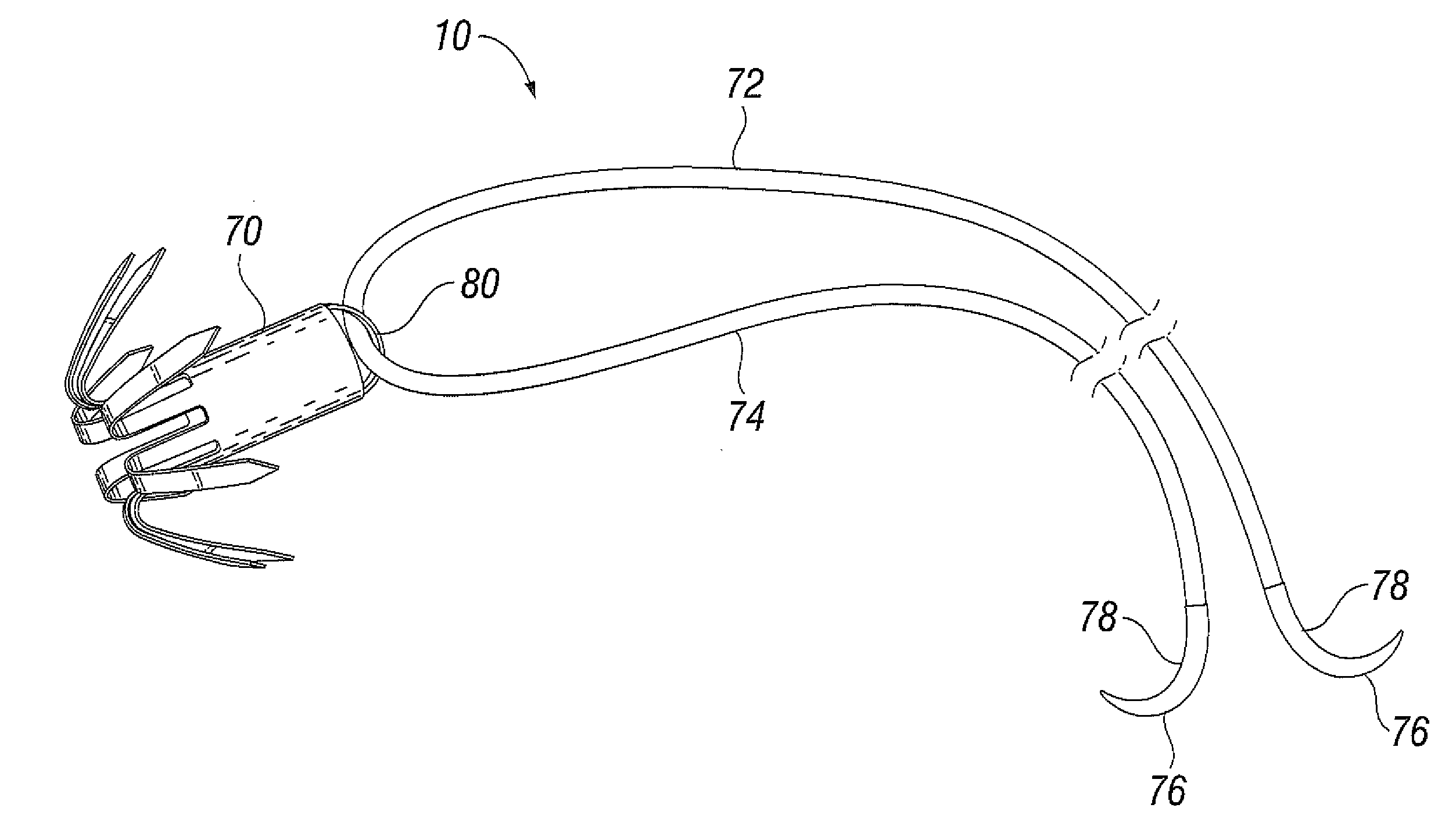 Suture and method for repairing a heart