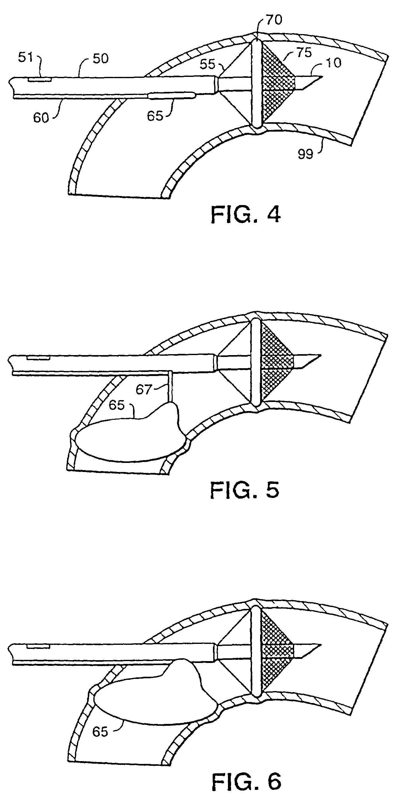 Aortic occluder with associated filter and methods of use during cardiac surgery