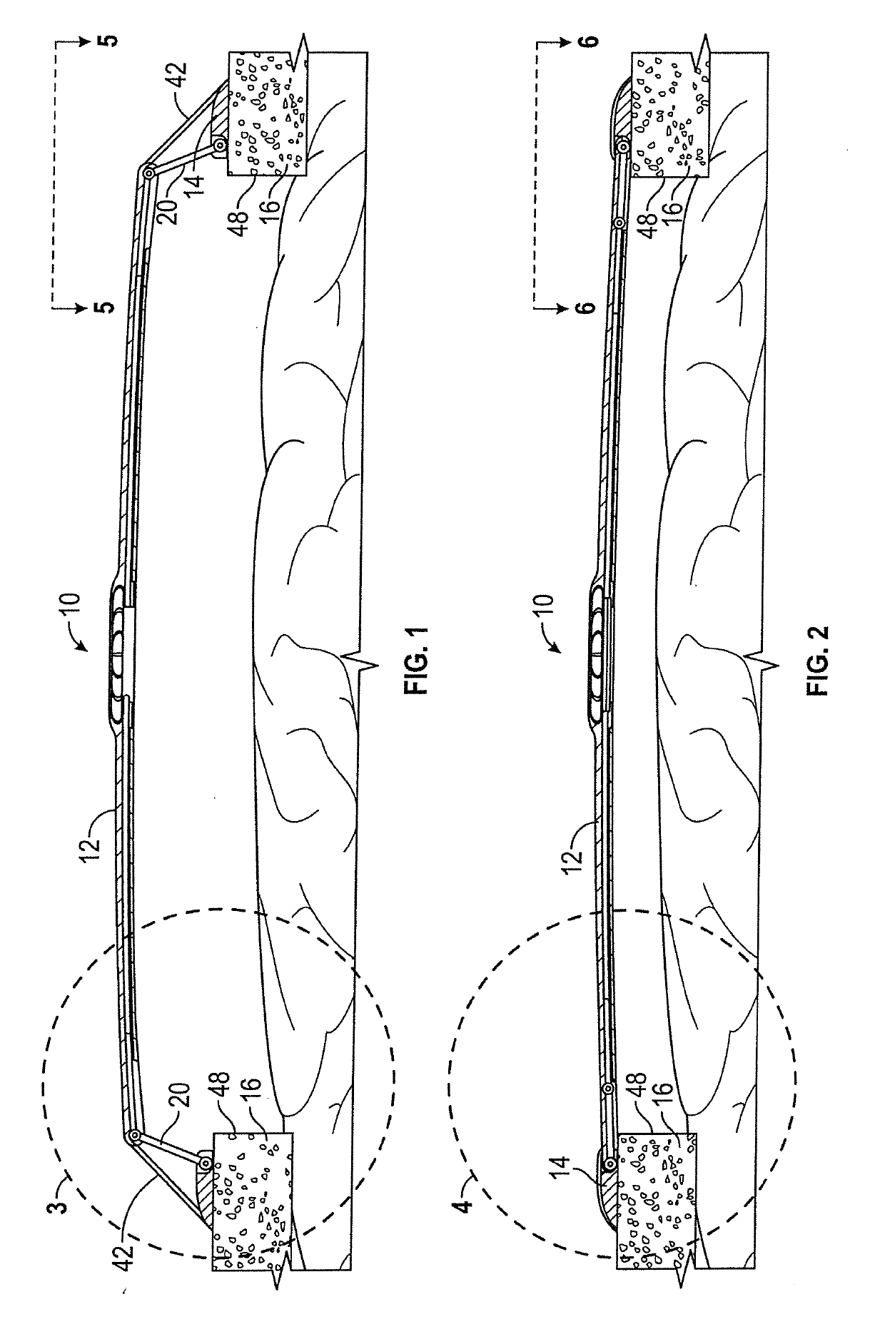 Cranioplasty Plate Assembly with Pivotal Struts