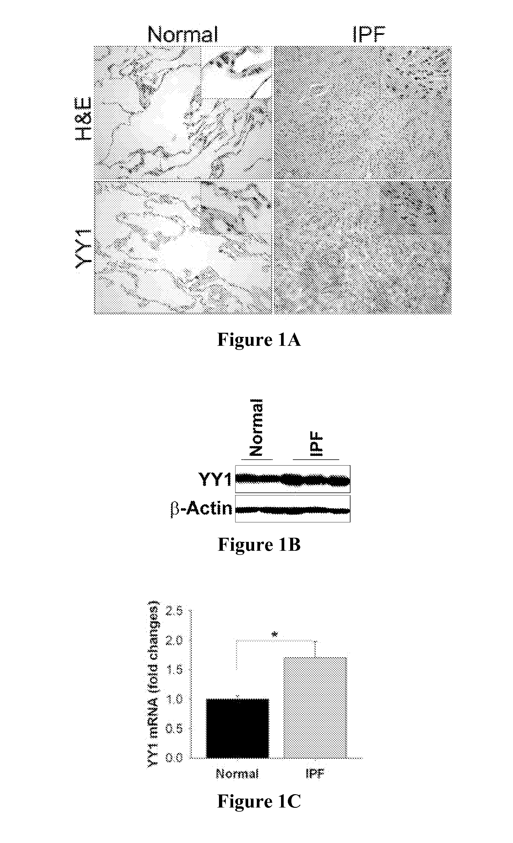 Methods of diagnosing and treating fibrosis