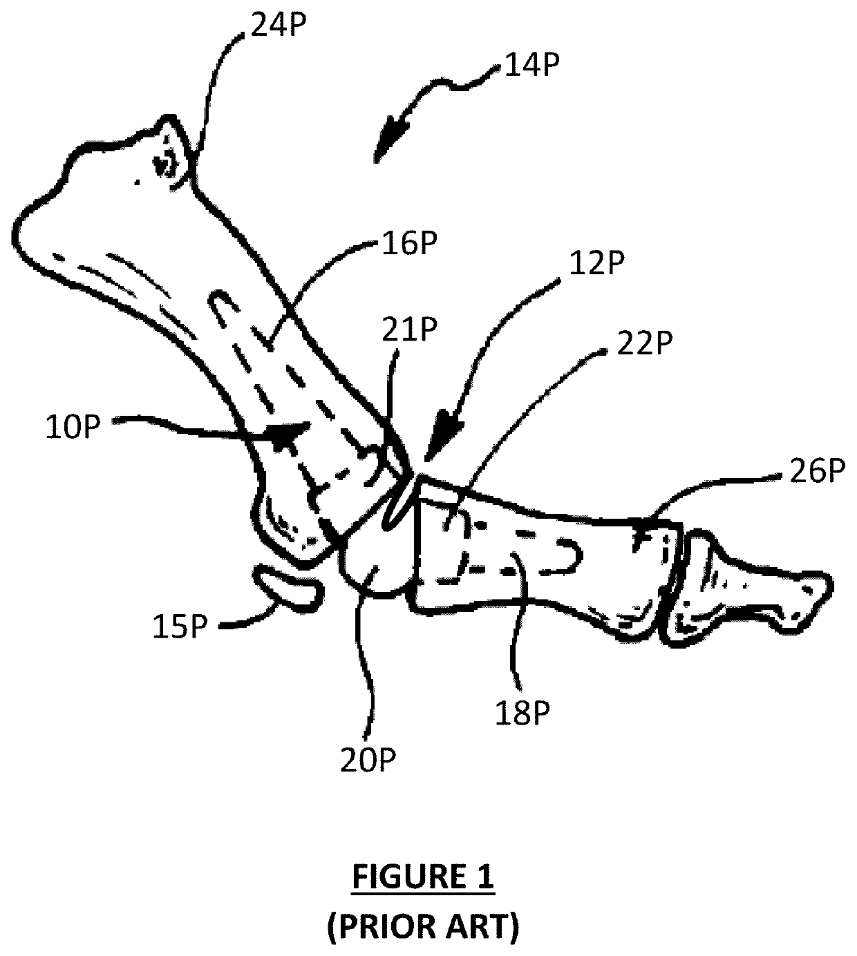 Motion toe systems and methods