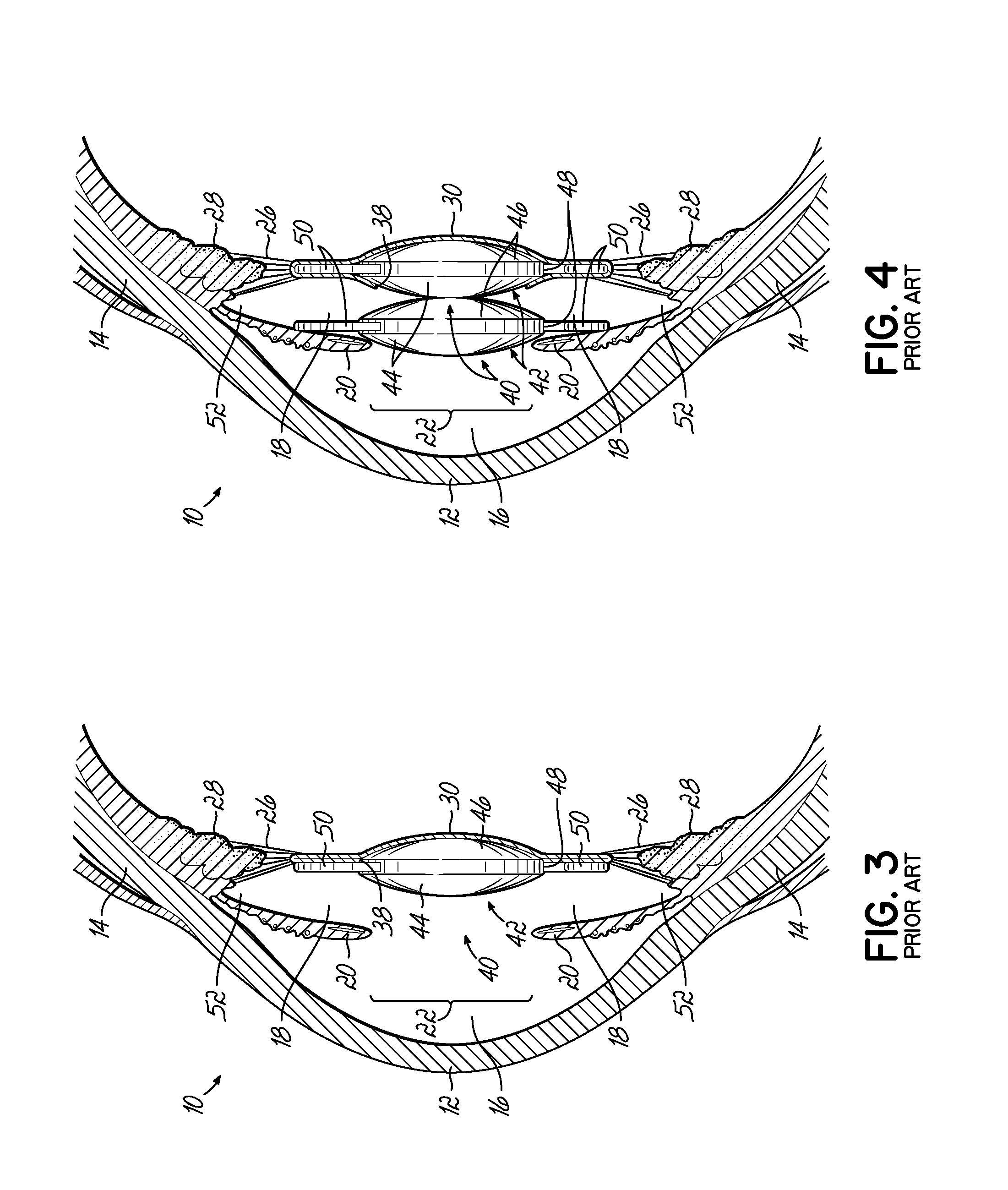 Anti-dysphotopic intraocular lens and method