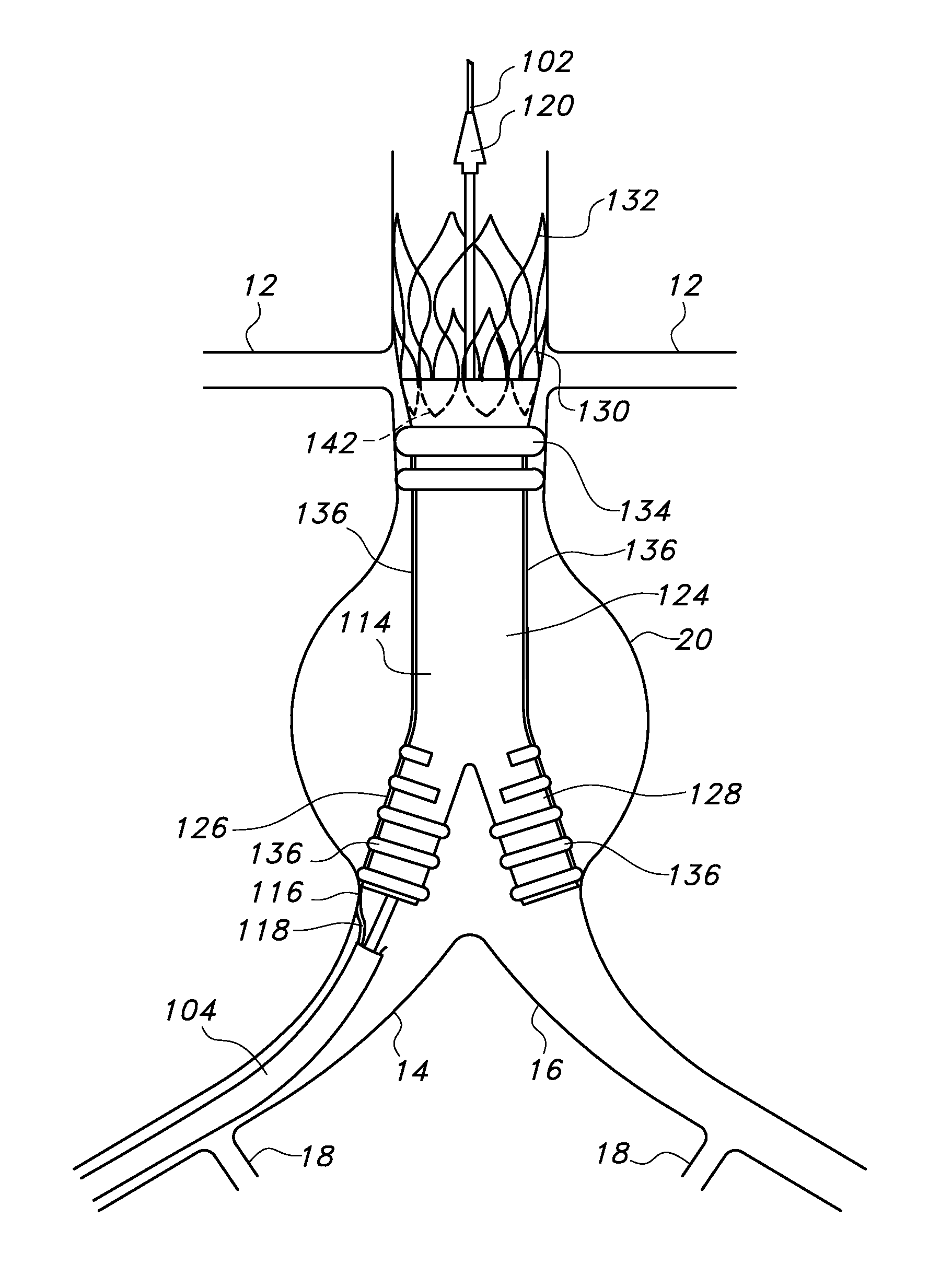Bifurcated endovascular prosthesis having tethered contralateral leg