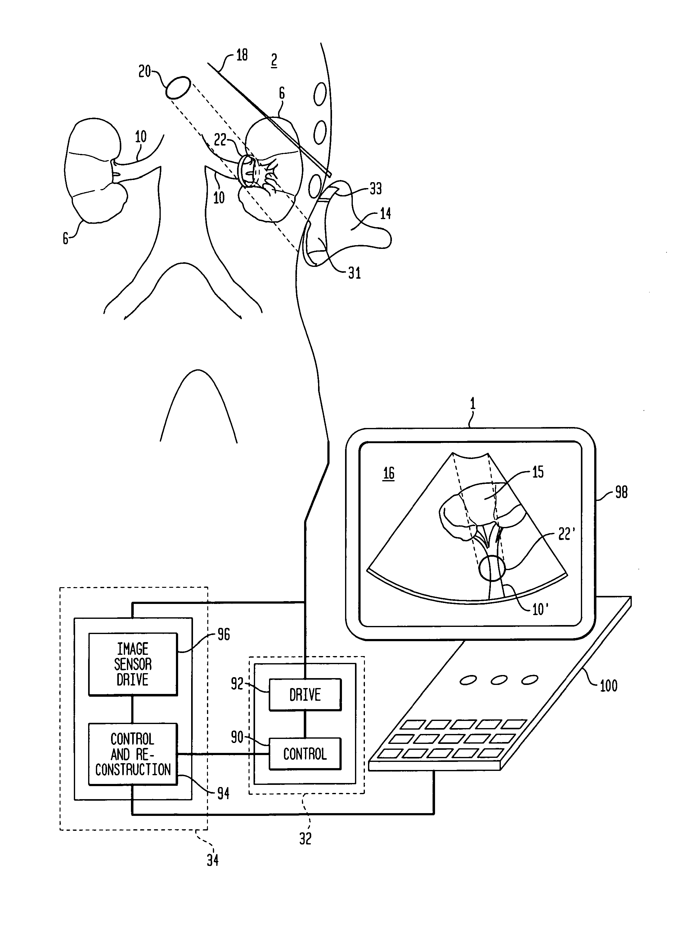 Method and apparatus for non-invasive treatment of hypertension through ultrasound renal denervation