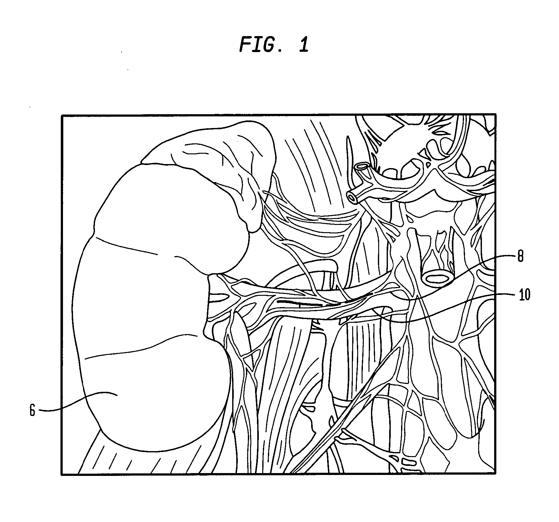 Method and apparatus for non-invasive treatment of hypertension through ultrasound renal denervation
