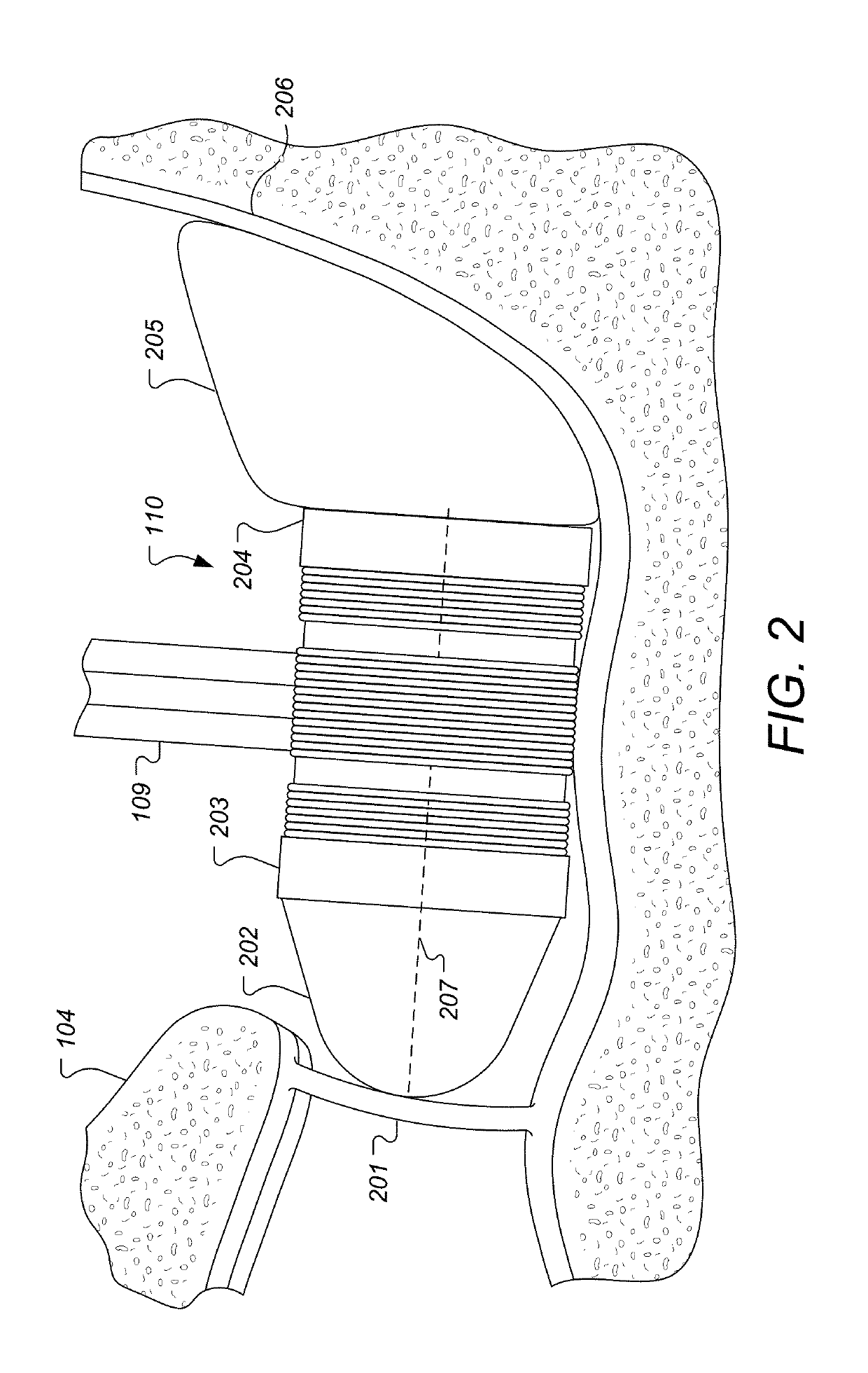 S-shaped coupling spring for middle ear implants