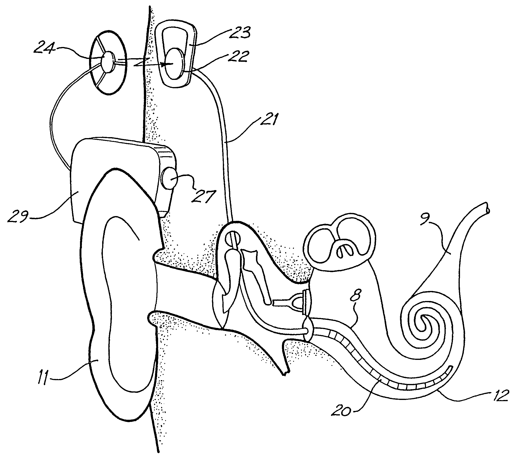 Variable sensitivity control for a cochlear implant