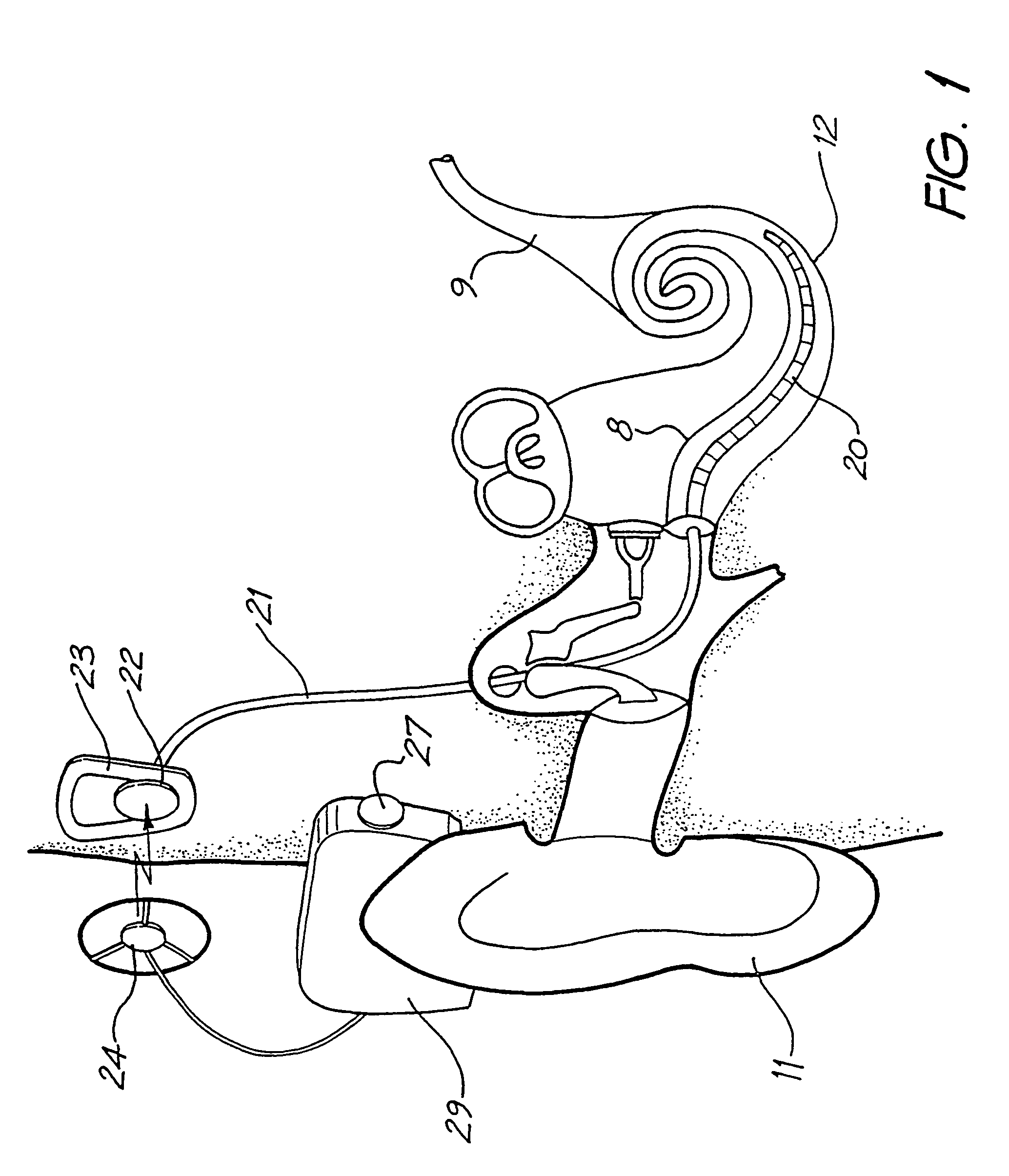 Variable sensitivity control for a cochlear implant