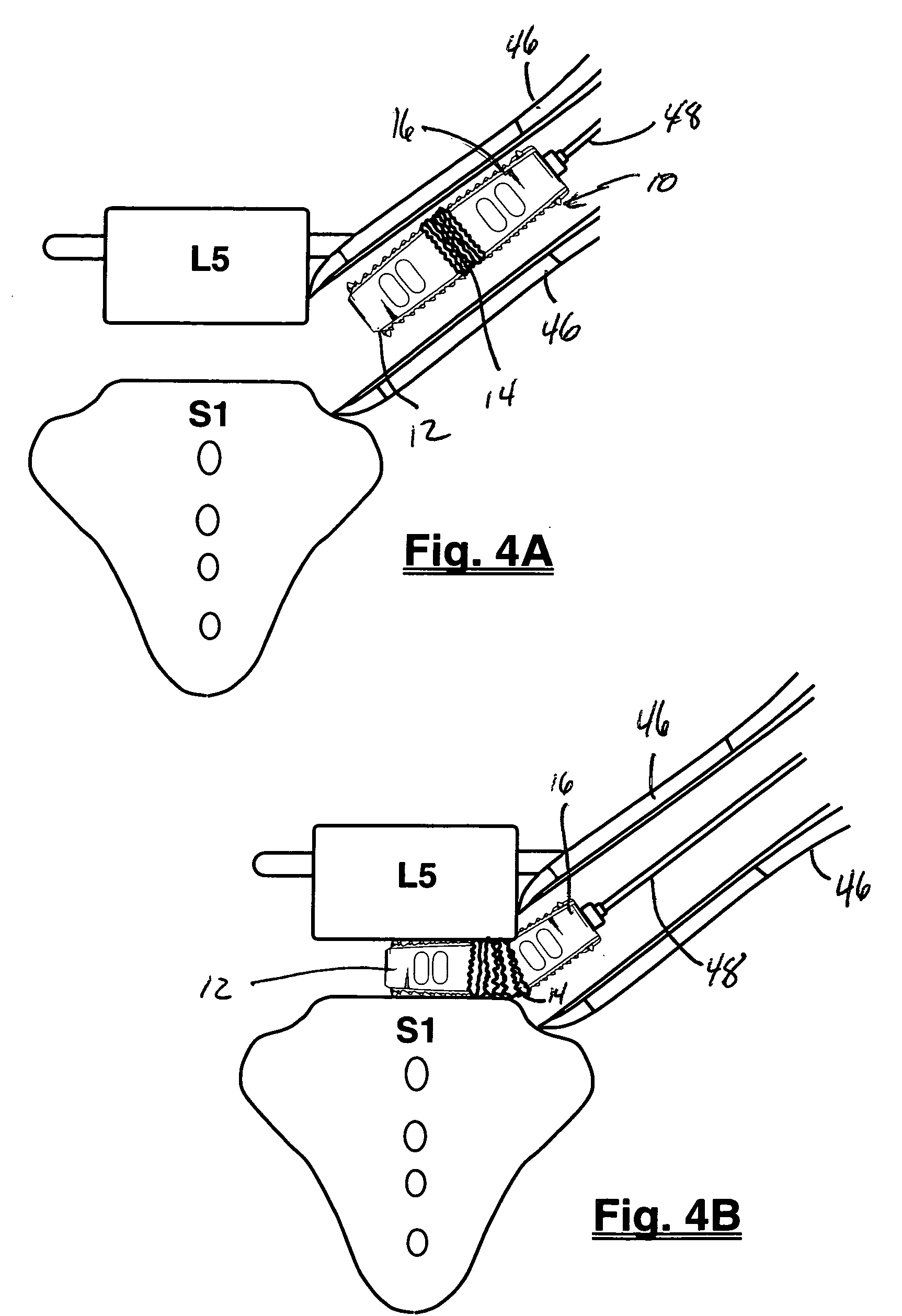 Spinal Surgical Implant and Related Methods