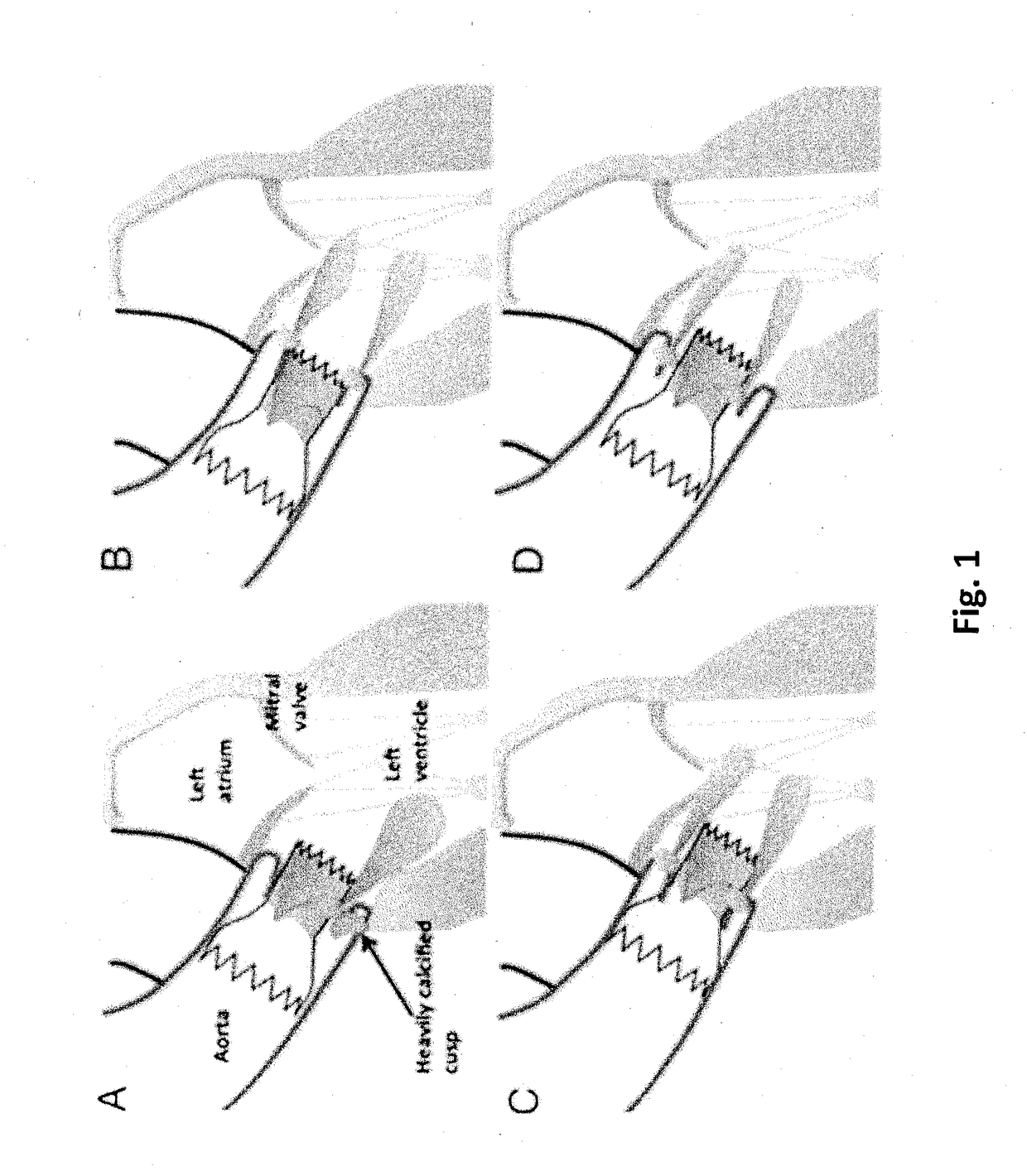 Ultrasound-guided delivery system for accurate positioning/repositioning of transcatheter heart valves