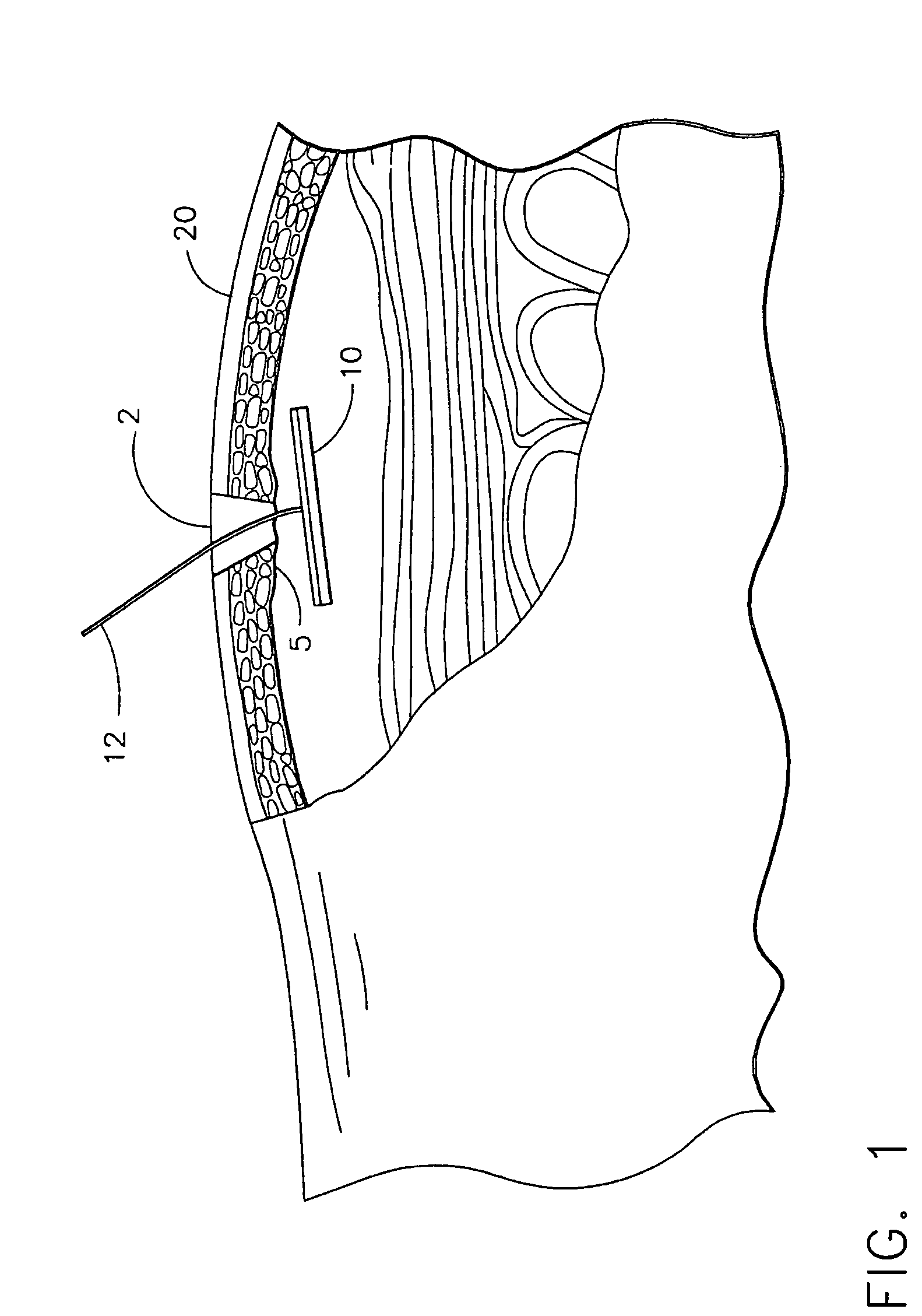 Method and device for minimally invasive implantation of biomaterial