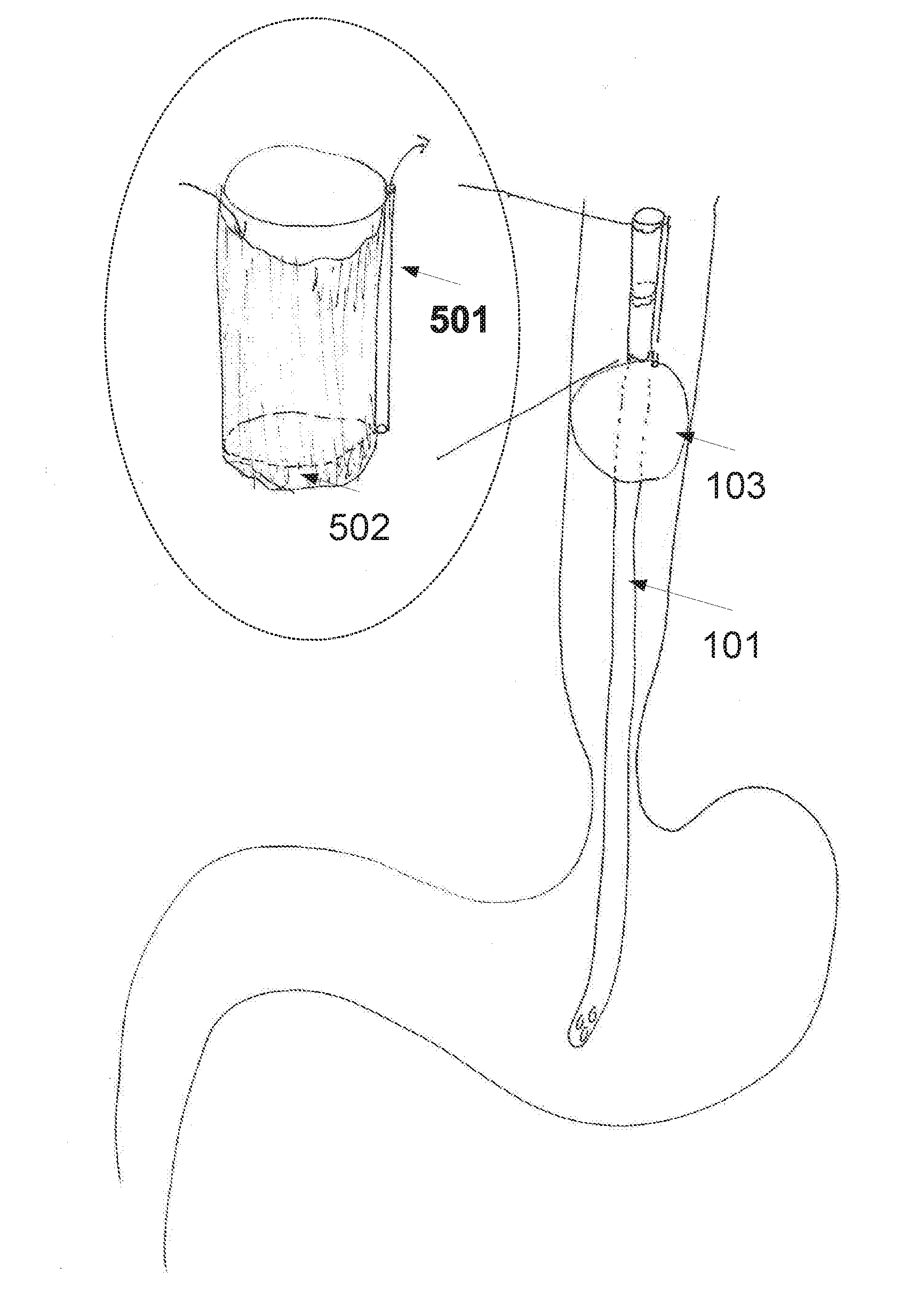 Method and device of detecting and/or blocking reflux