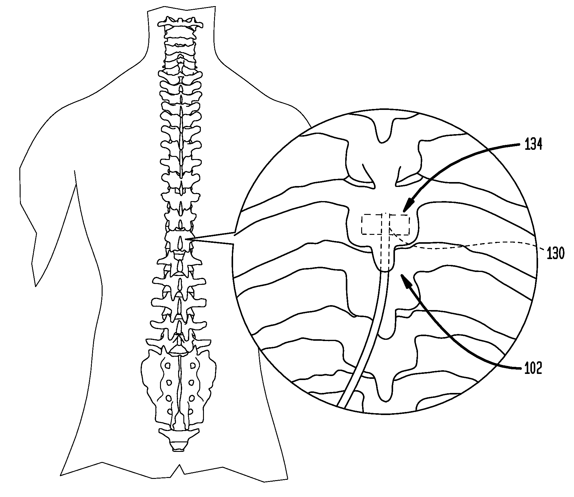 Methods and apparatus for spinal cord stimulation using expandable electrode