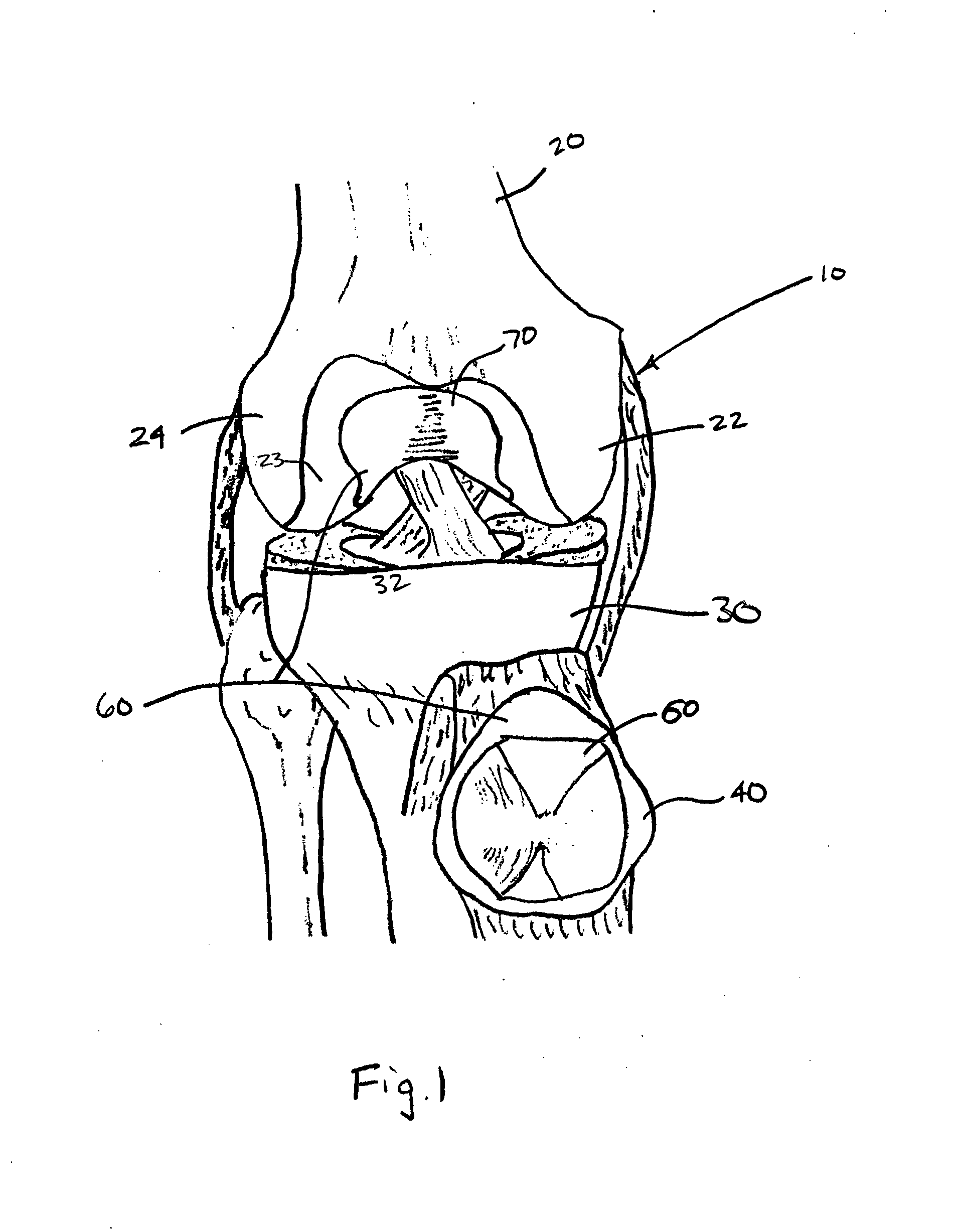 Patello-femoral prosthesis