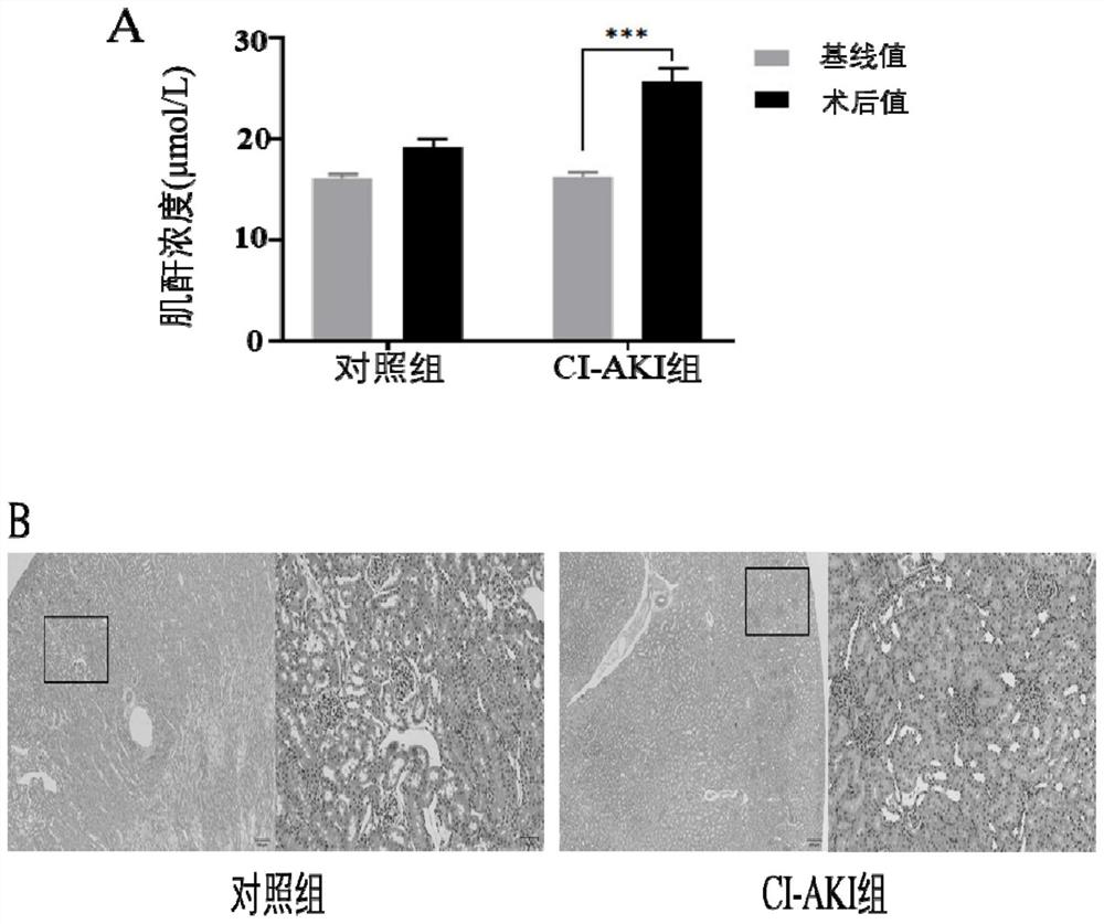 Application of long-chain non-coding RNA as biomarker to diagnosis of contrast-induced acute kidney injury (CI-AKI)