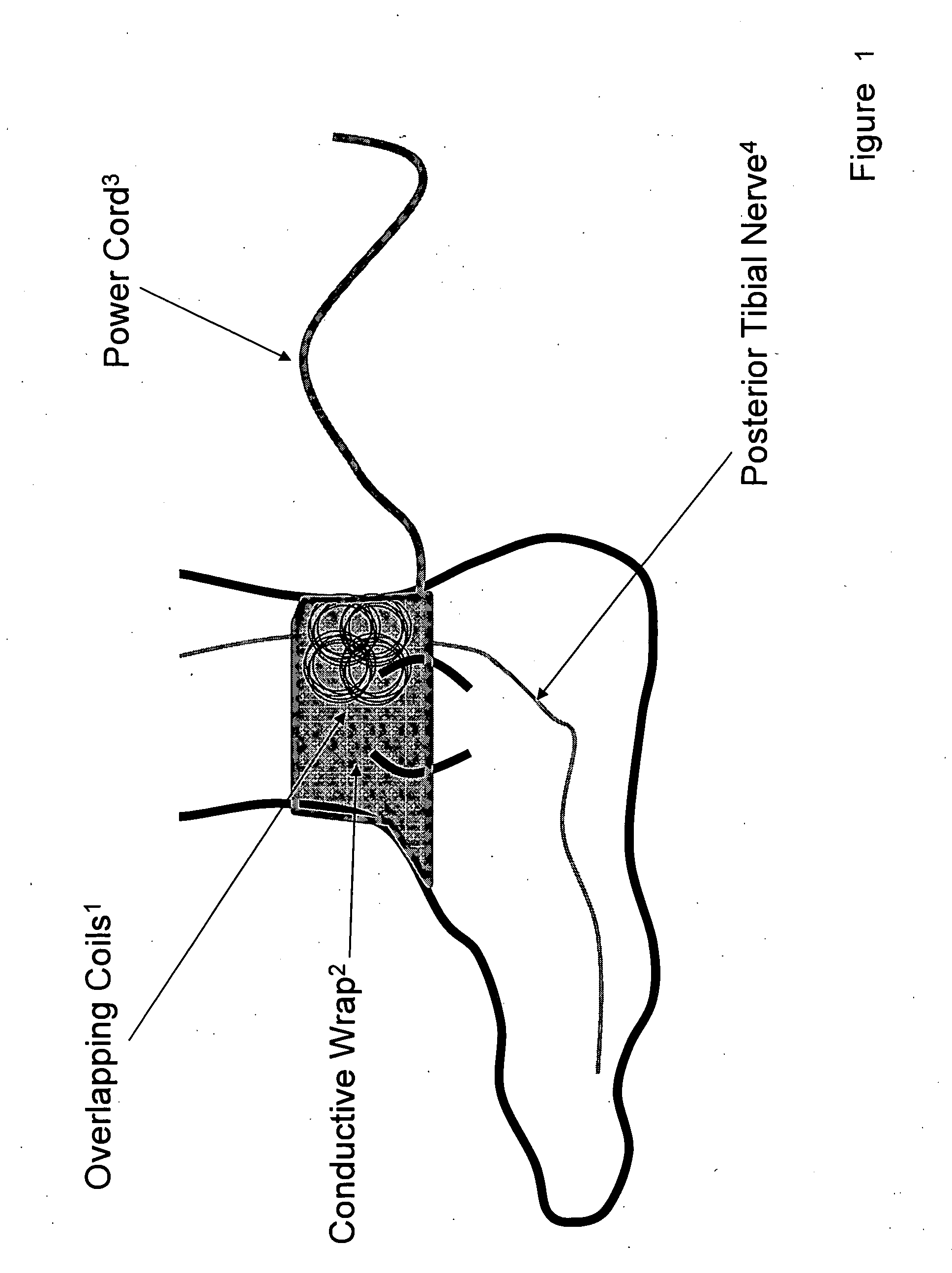 Method and apparatus for low frequency induction therapy for the treatment of urinary incontinence and overactive bladder