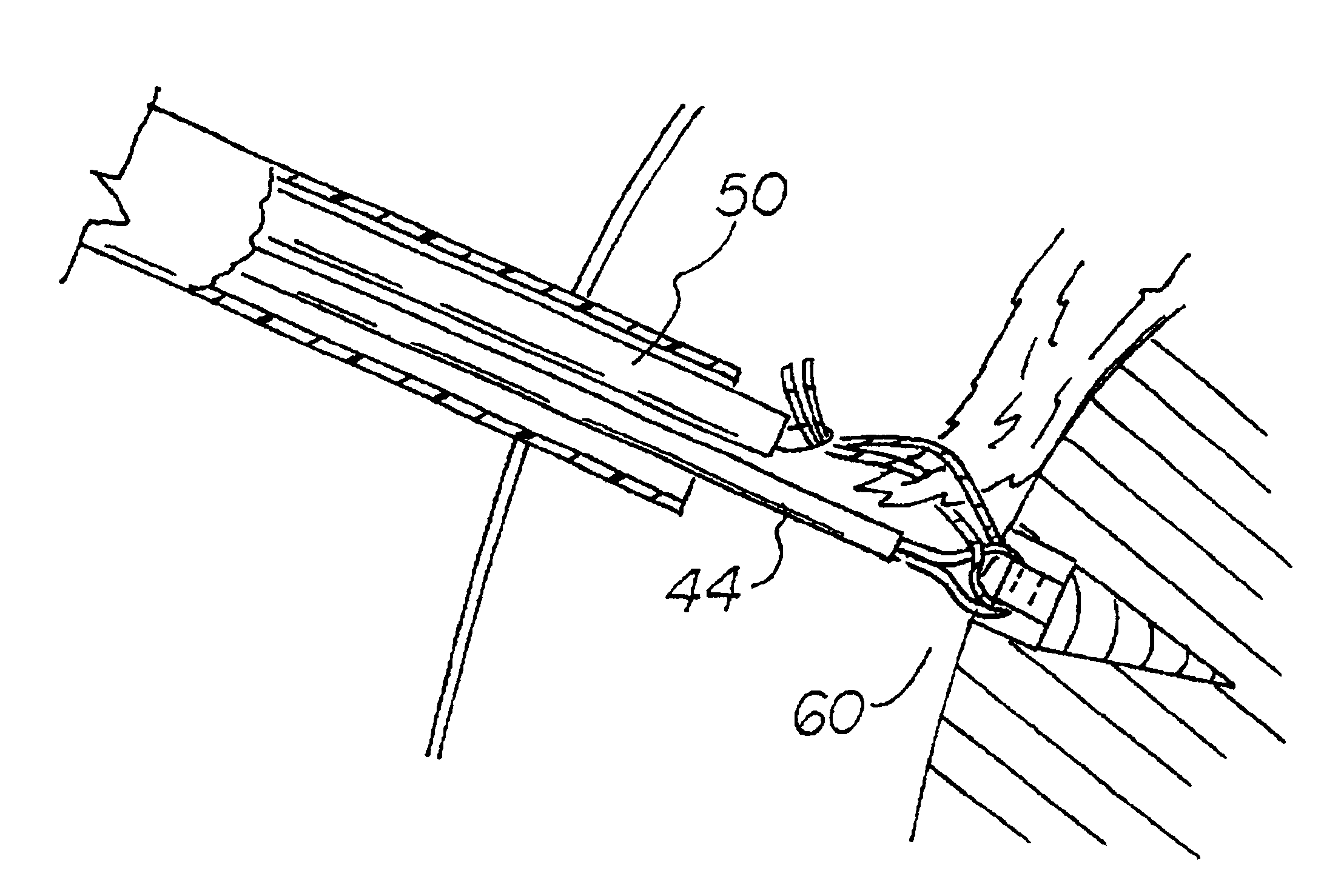 Suture management method and system