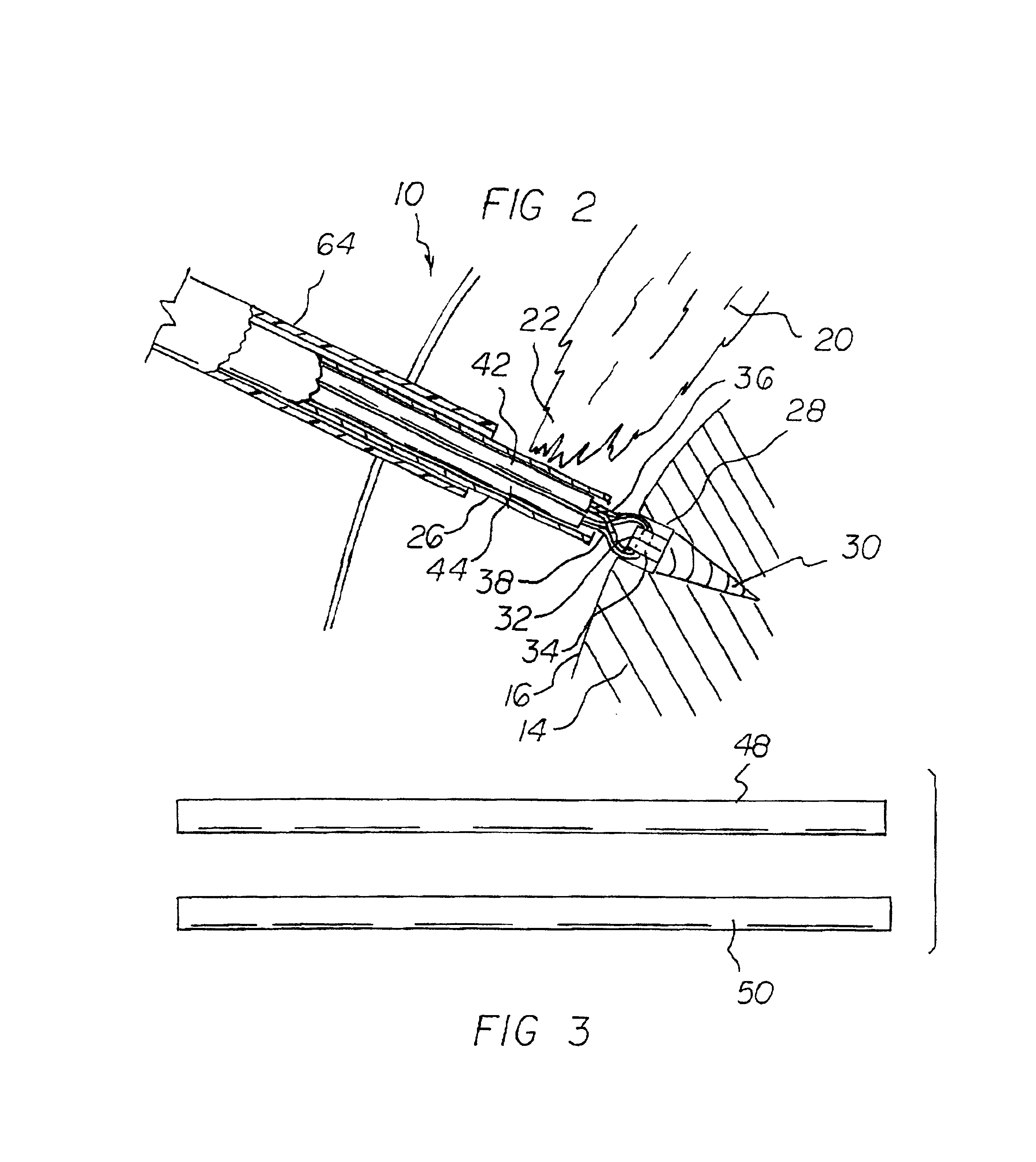 Suture management method and system