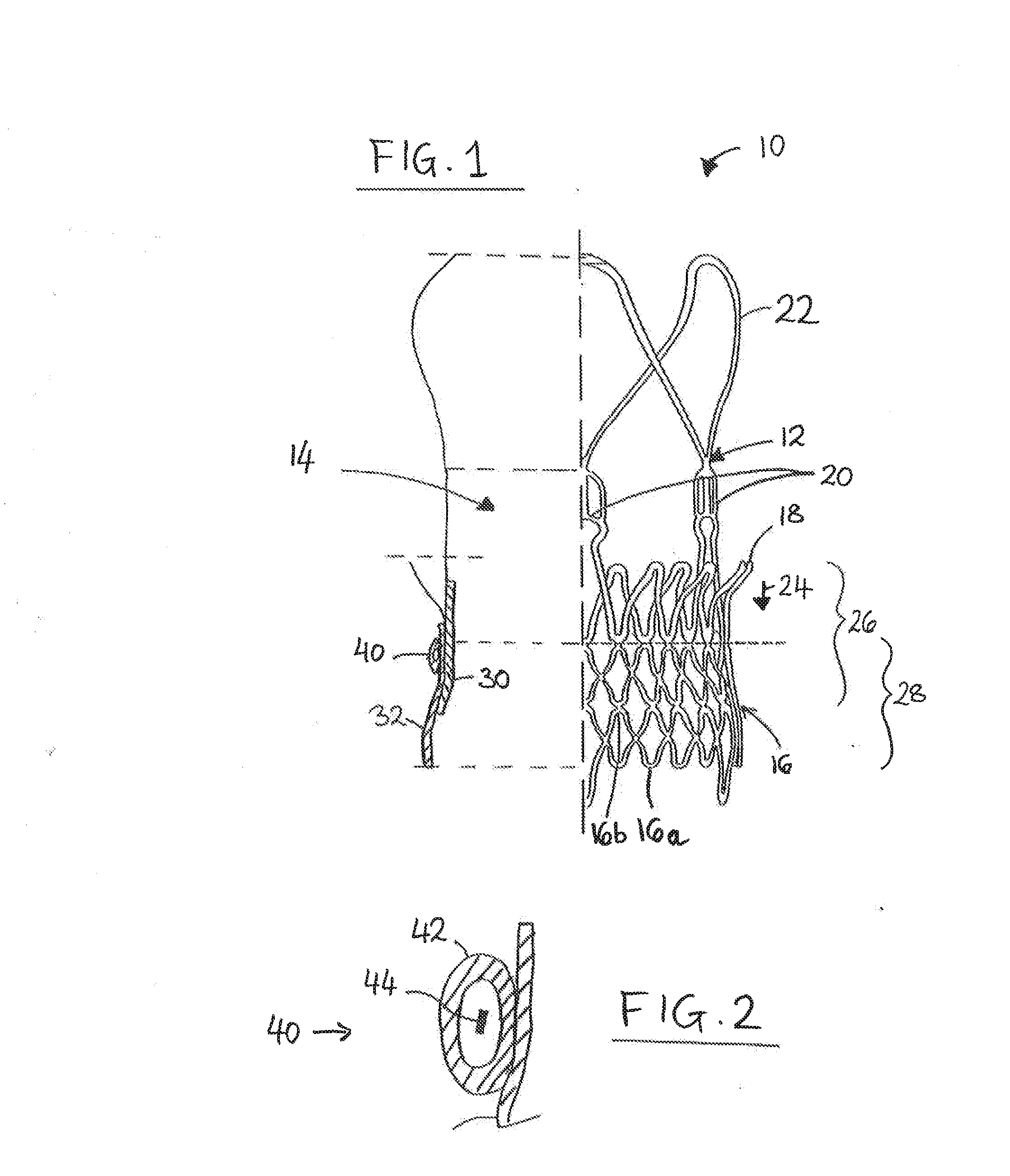 Prosthesis Seals and Methods for Sealing an Expandable Prosthesis