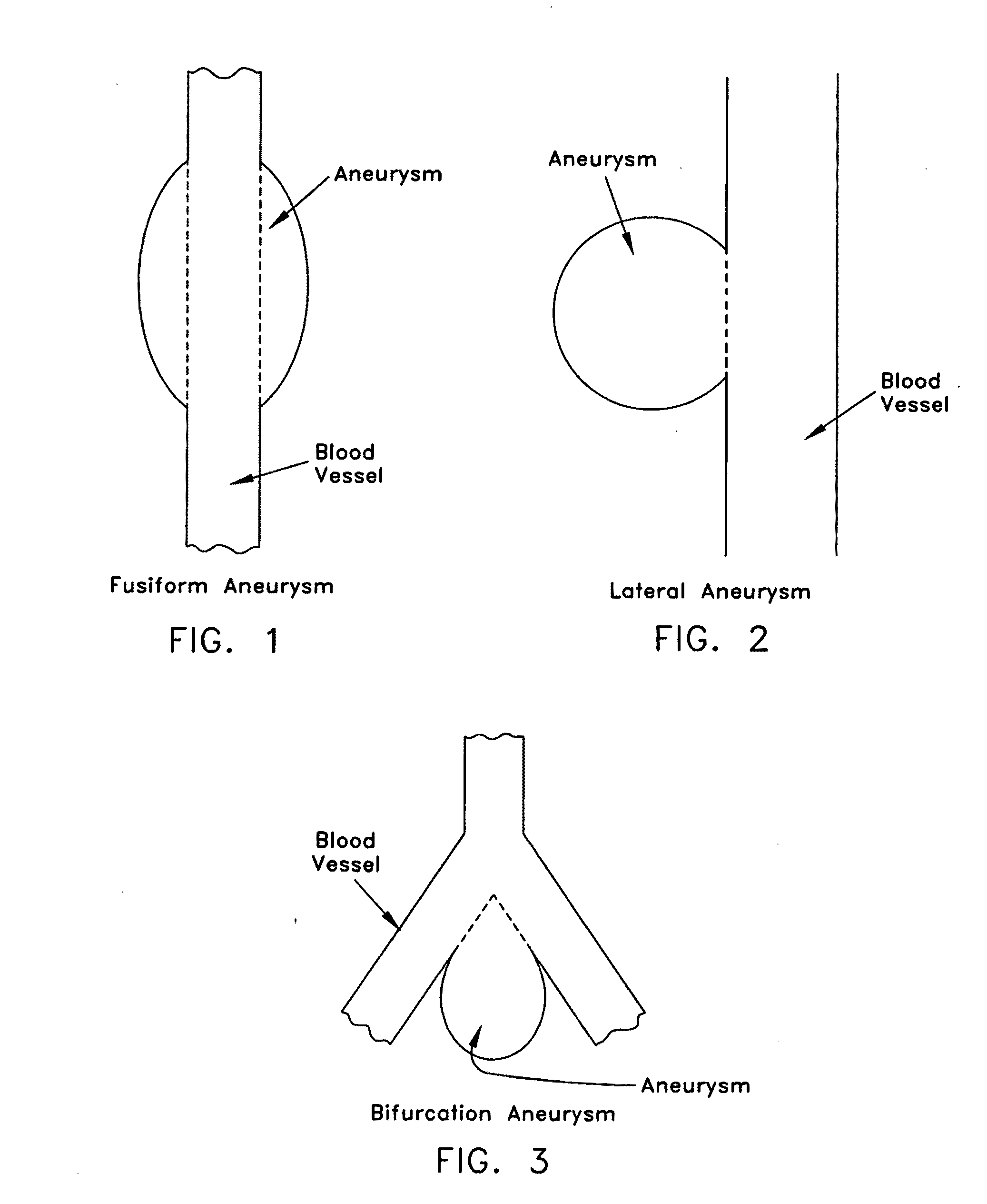 Method and apparatus for restricting flow through an opening in the side wall of a body lumen, and/or for reinforcing a weakness in the side wall of a body lumen, while still maintaining substantially normal flow through the body lumen