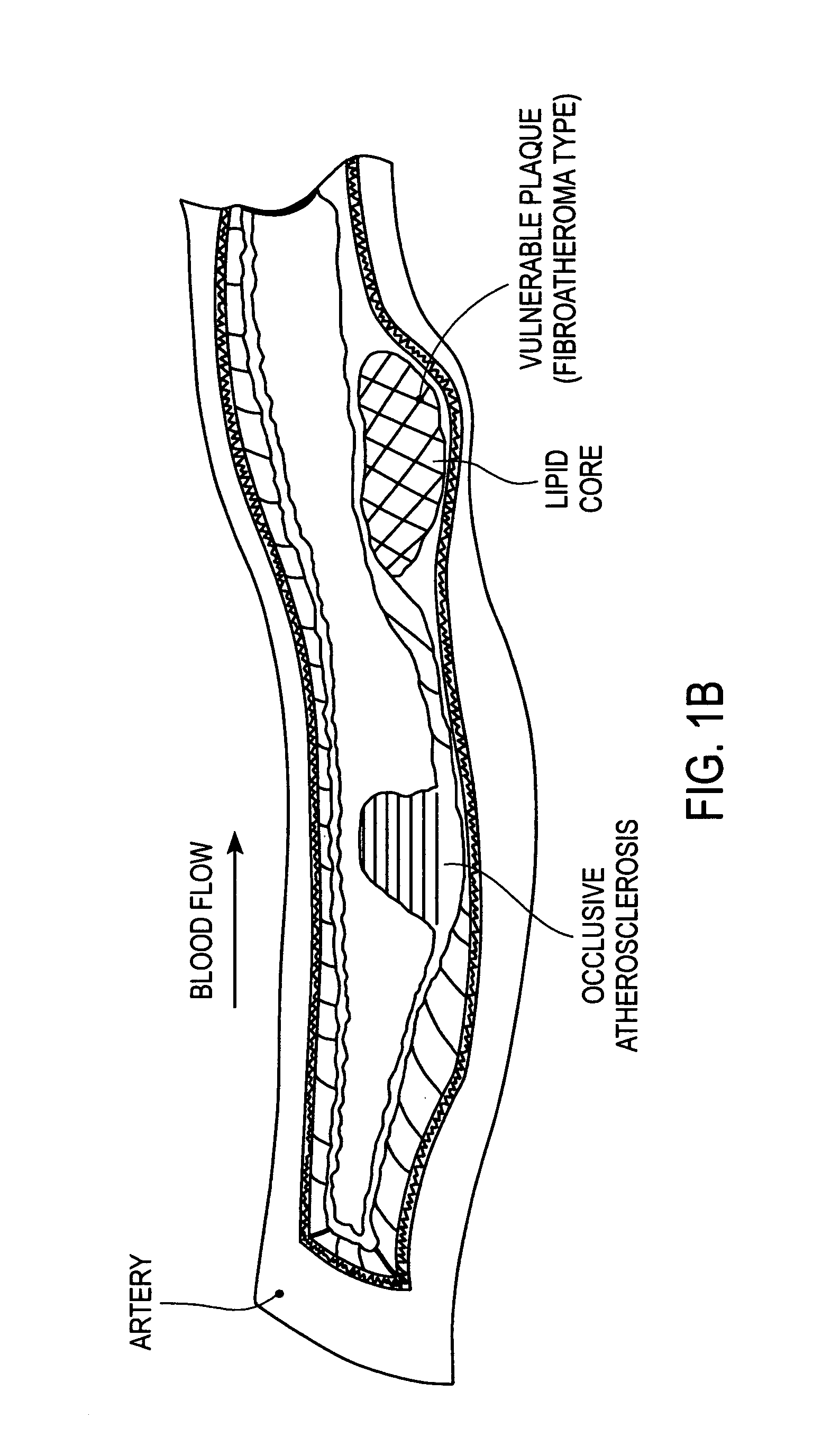 Method and apparatus for treating vulnerable plaque