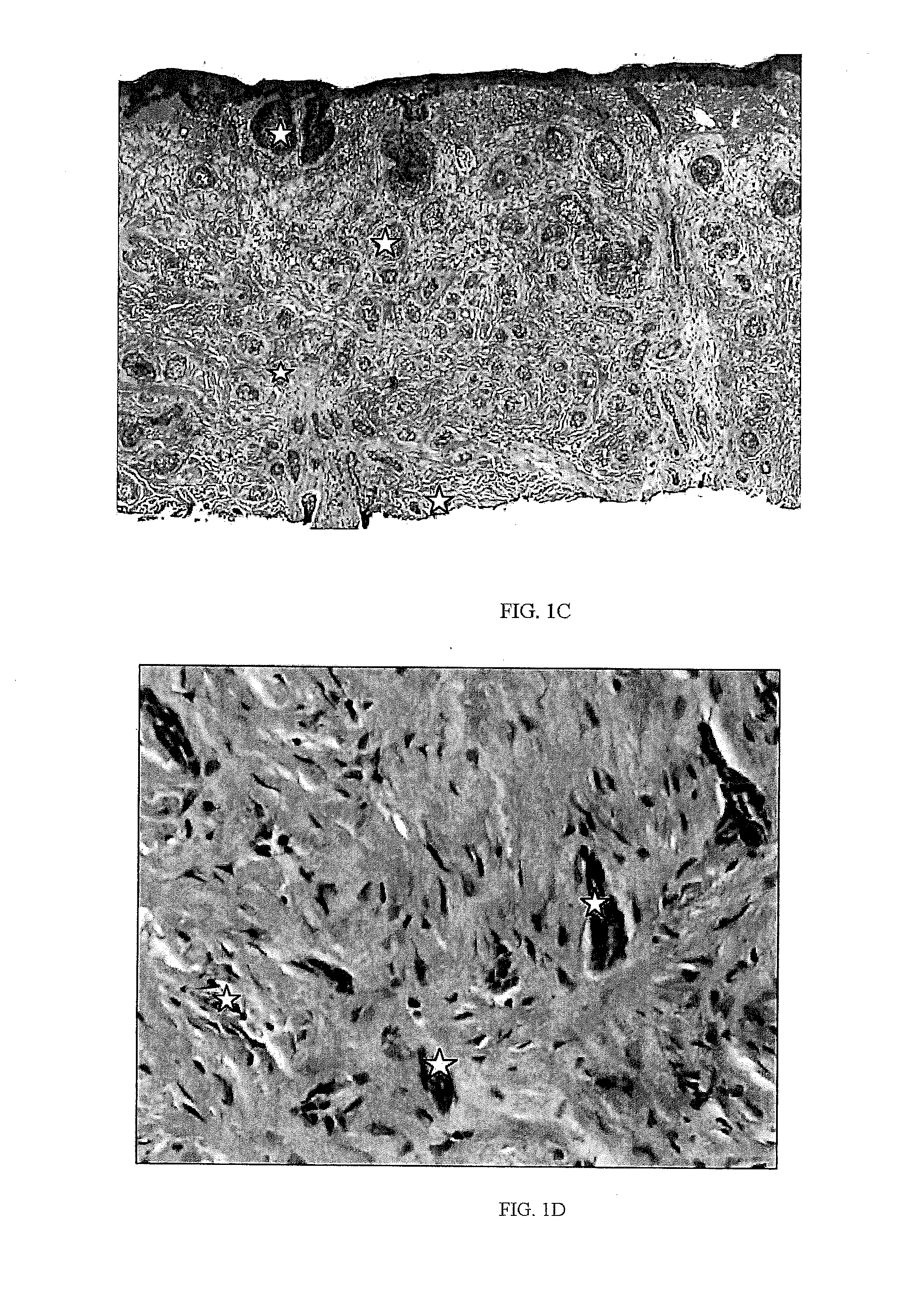 Method and Apparatus for Skin Cancer Thermal Therapy