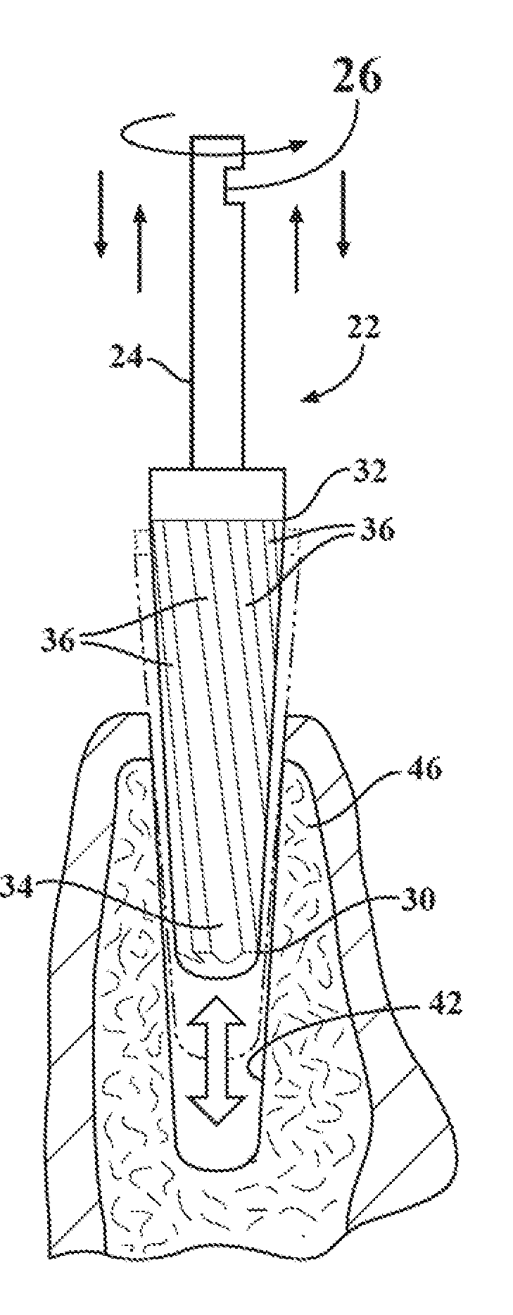 Fluted osteotome and surgical method for use