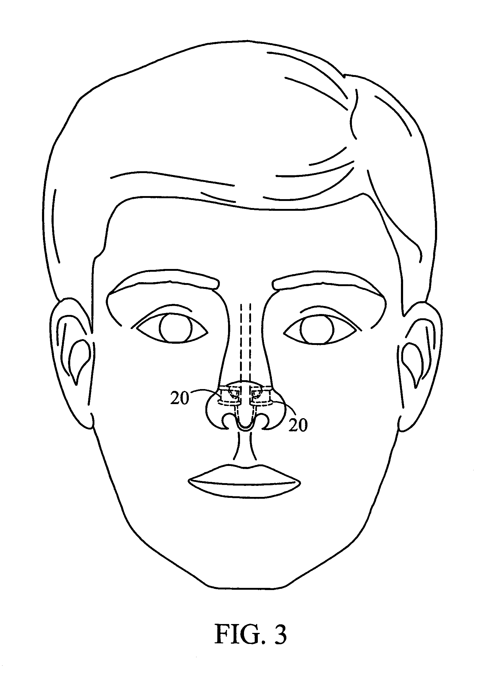 Nasal dilator
